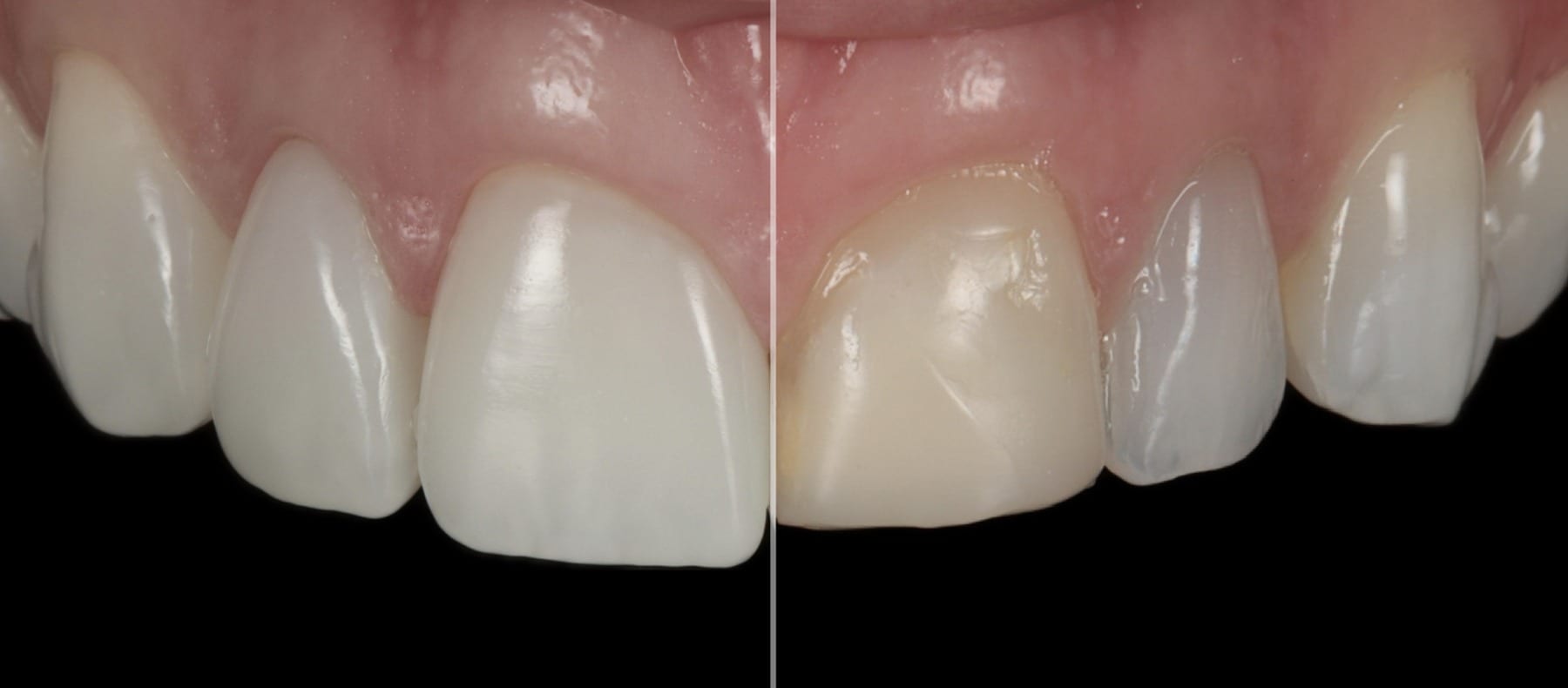 Before and after porcelain veneer