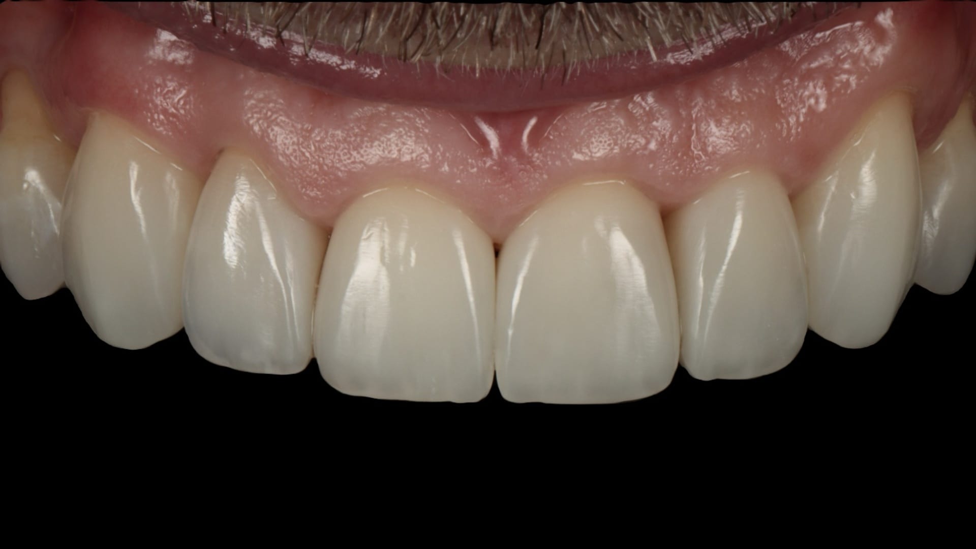 After — Black triangle closure — 6x composite veneers/bonding