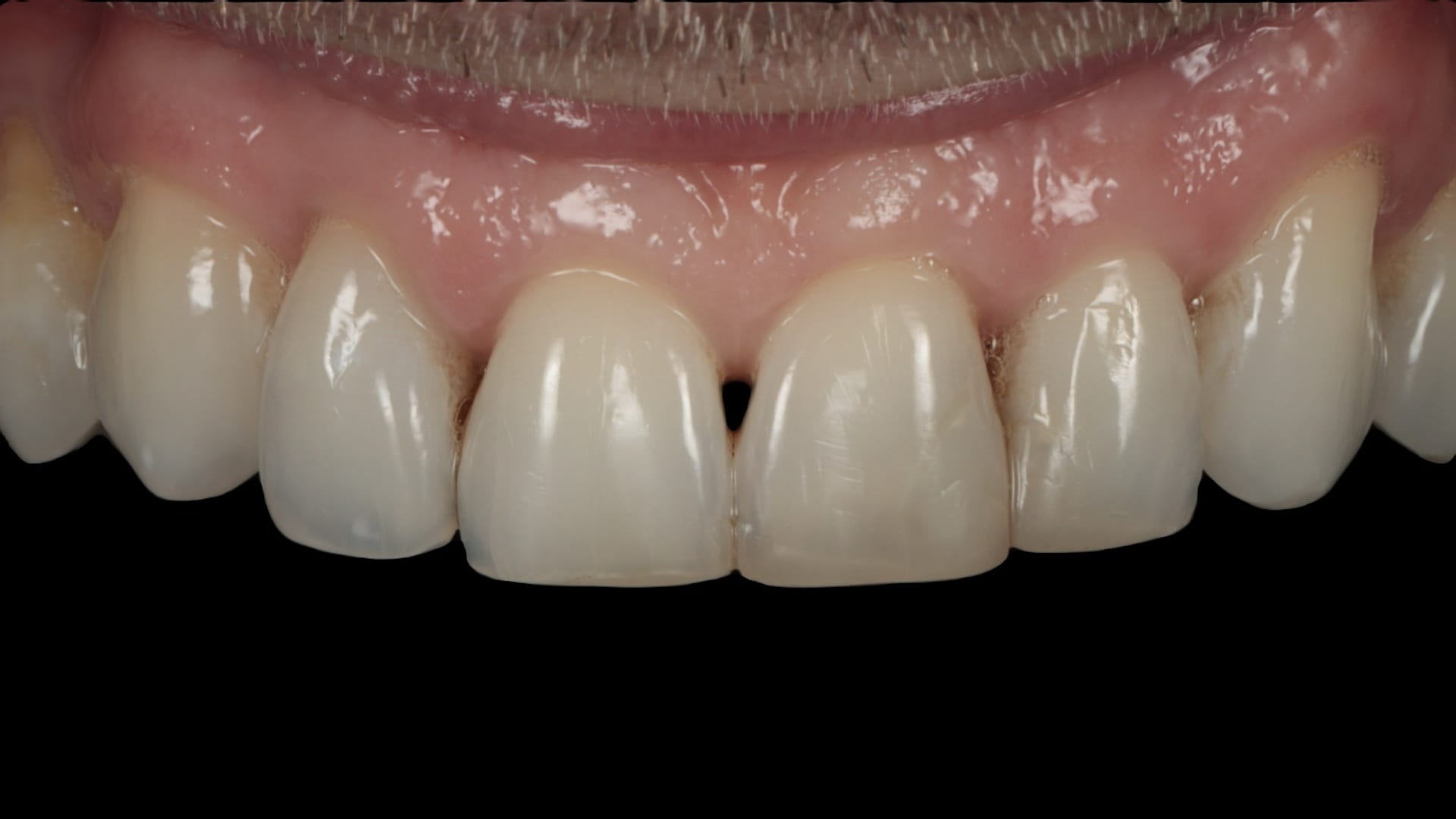 Before — Black triangle closure — 6x composite veneers/bonding