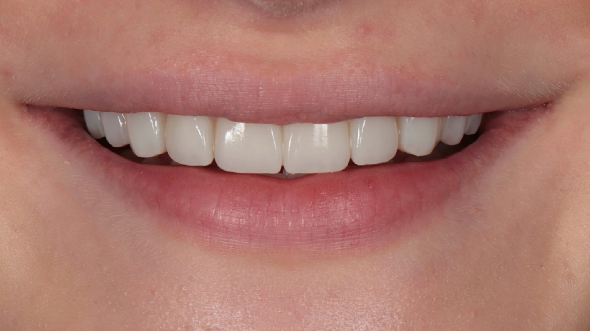 After — 10x natural composite veneers — broader, more visible smile