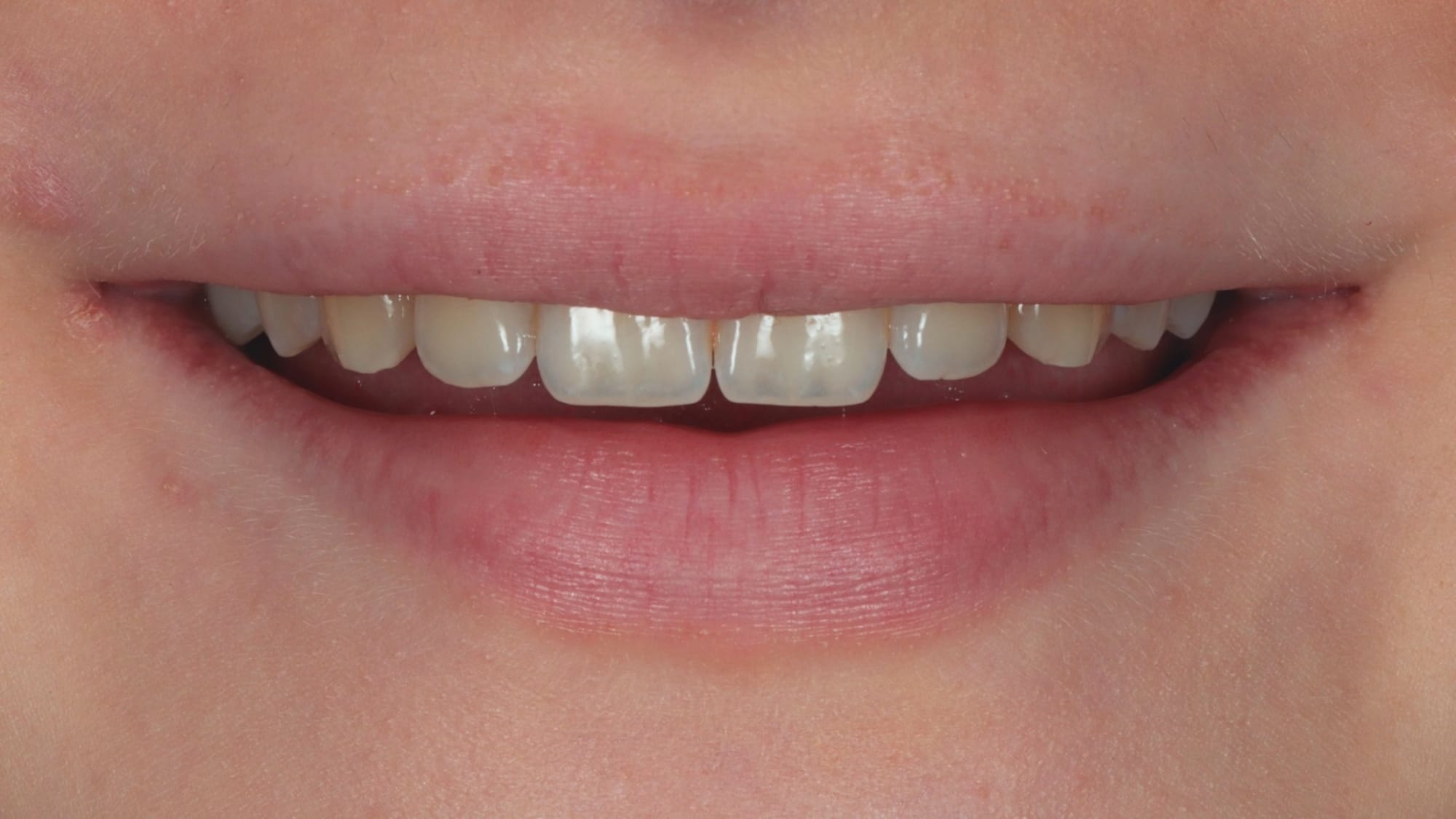 Before — 10x natural composite veneers — broader, more visible smile