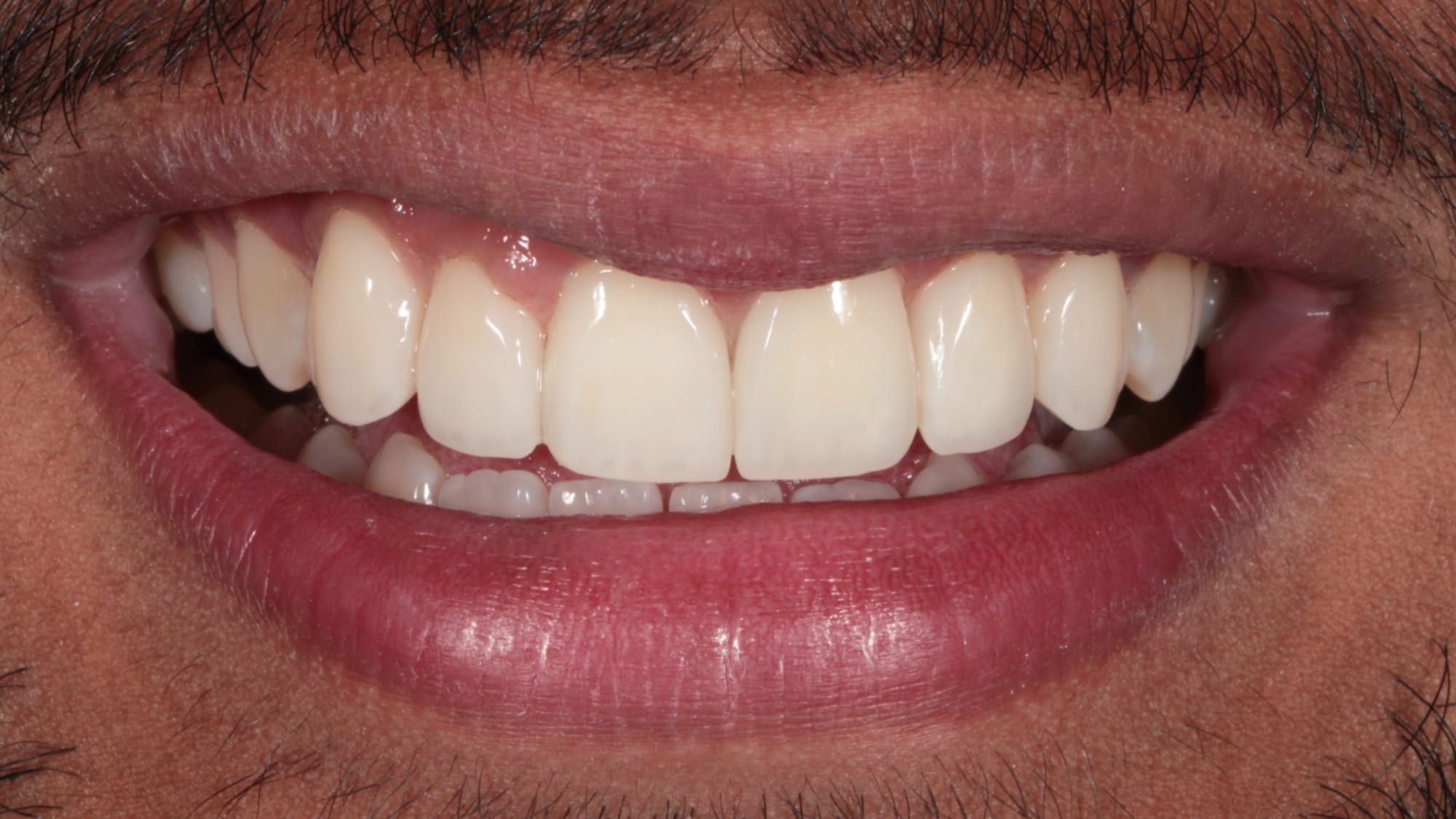 After — Closing spacing and gaps — 6x natural composite bonding
