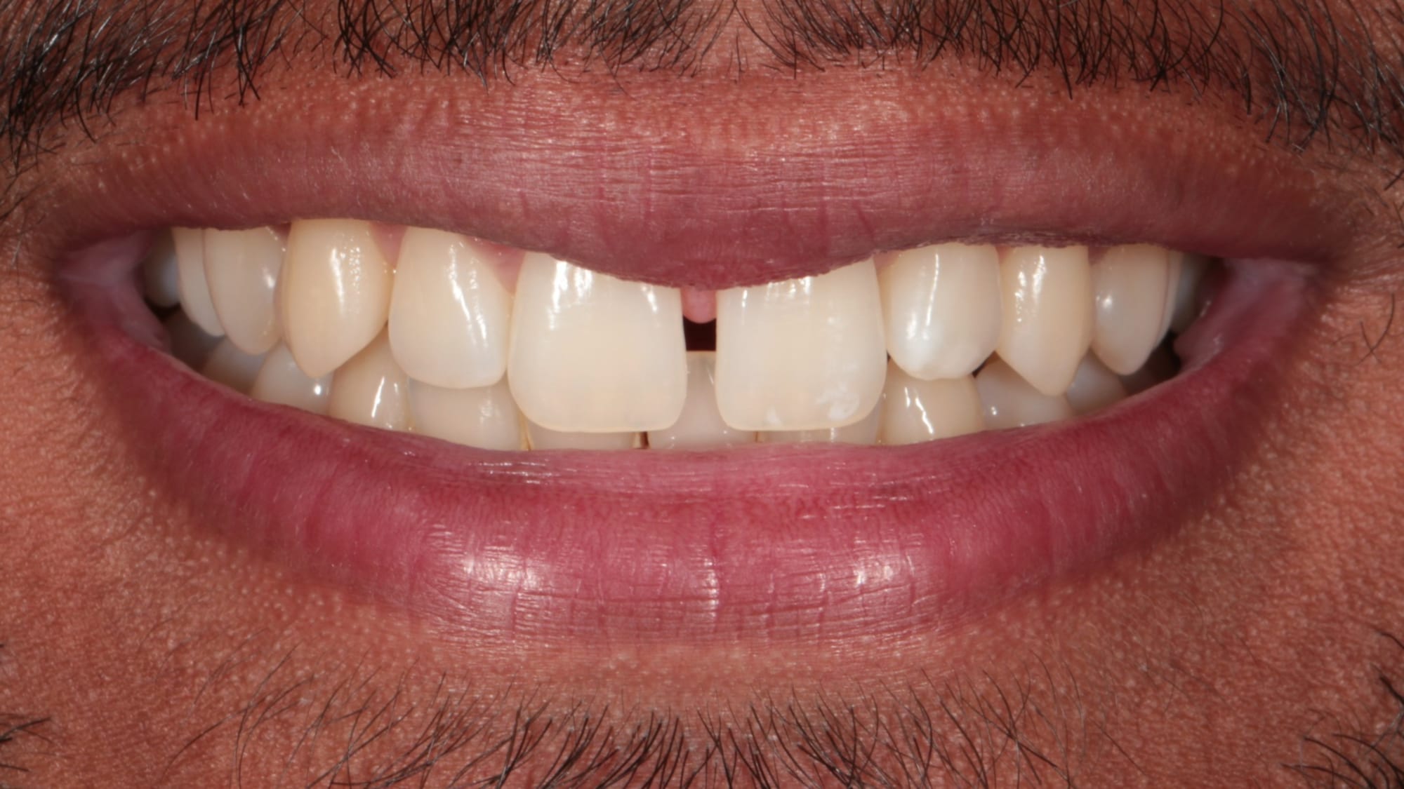 Before — Closing spacing and gaps — 6x natural composite bonding