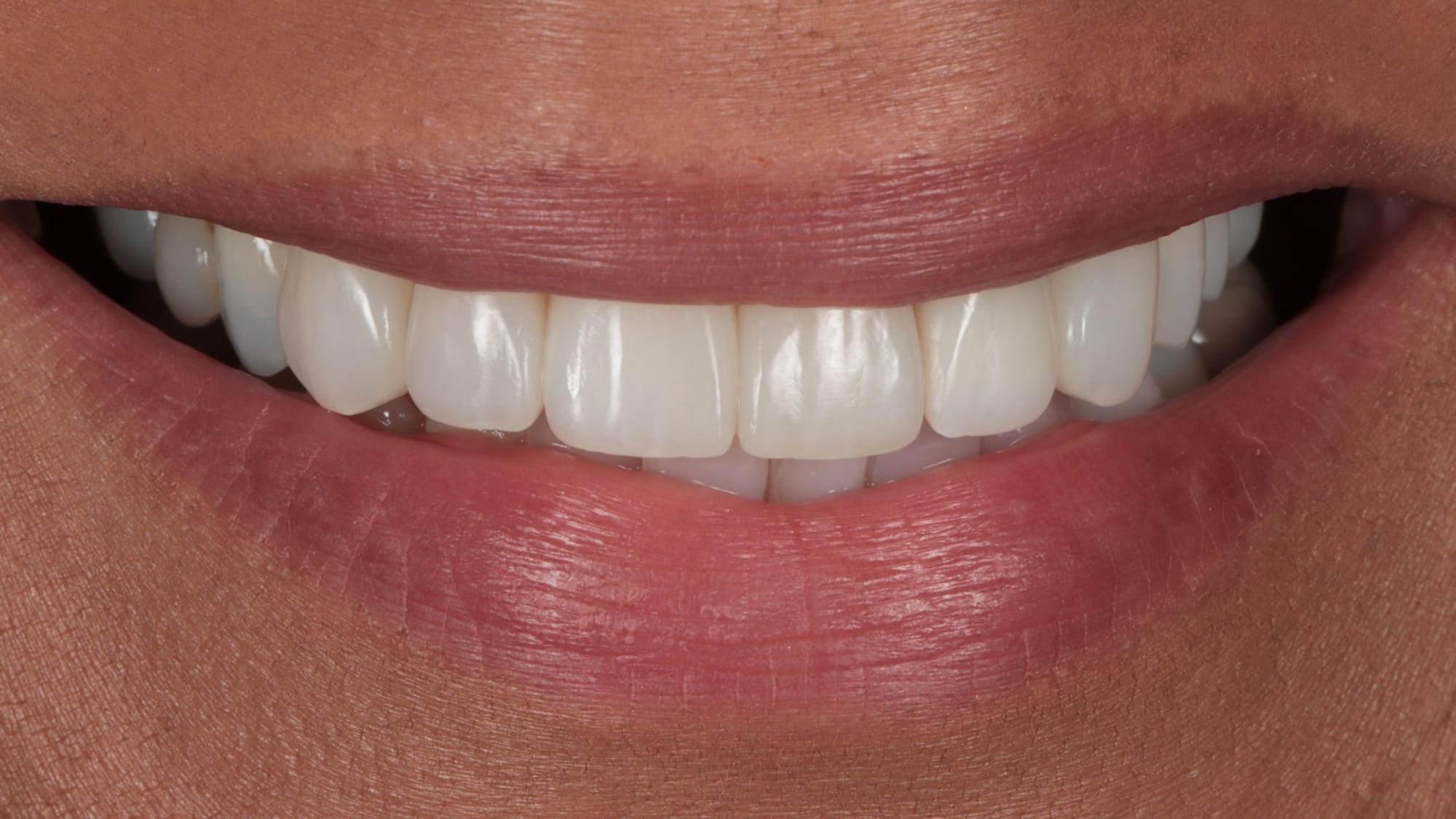 After — 6x composite veneers — replacing discoloured crown