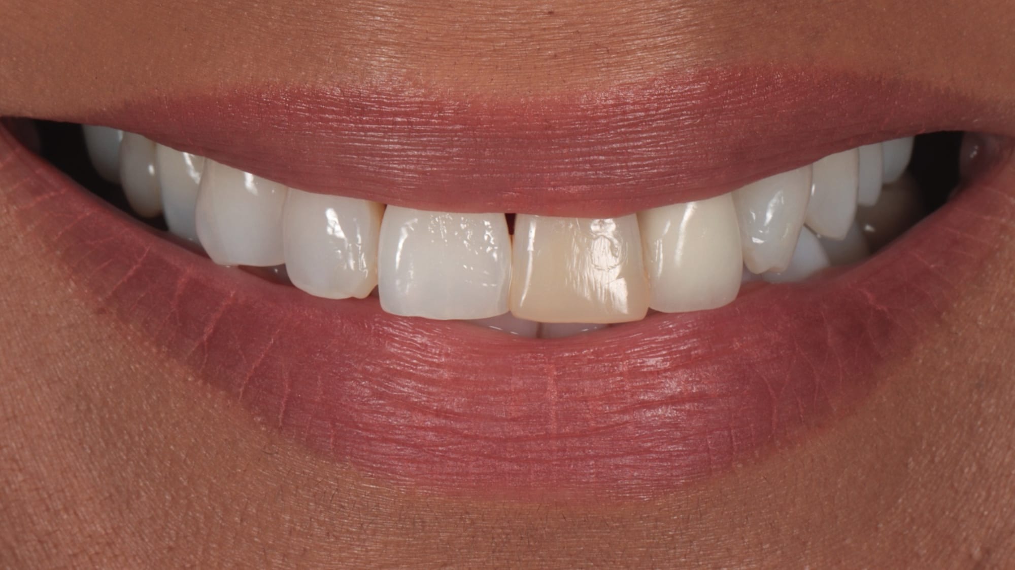 Before — 6x composite veneers — replacing discoloured crown