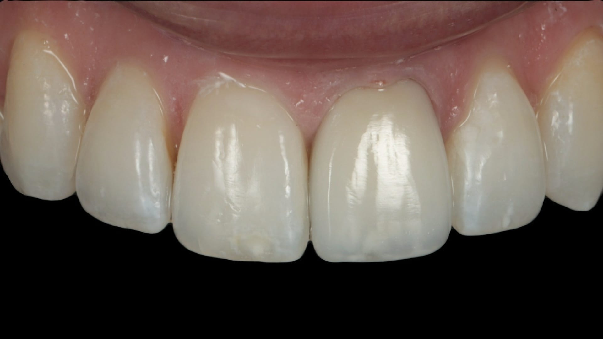 After — Discoloured veneer replaced — 1x advanced composite veneer