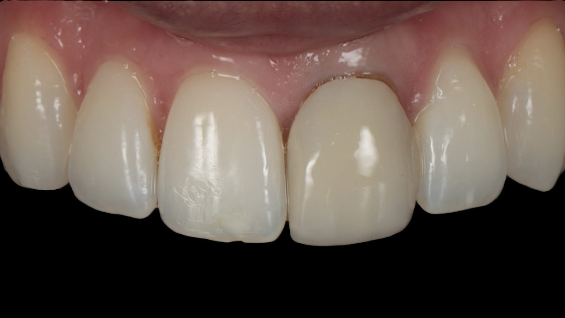 Before — Discoloured veneer replaced — 1x advanced composite veneer