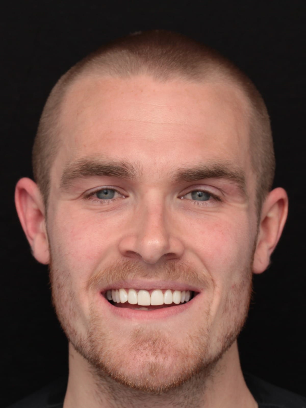 After — 6x Hollywood composite veneers — treating discolouration