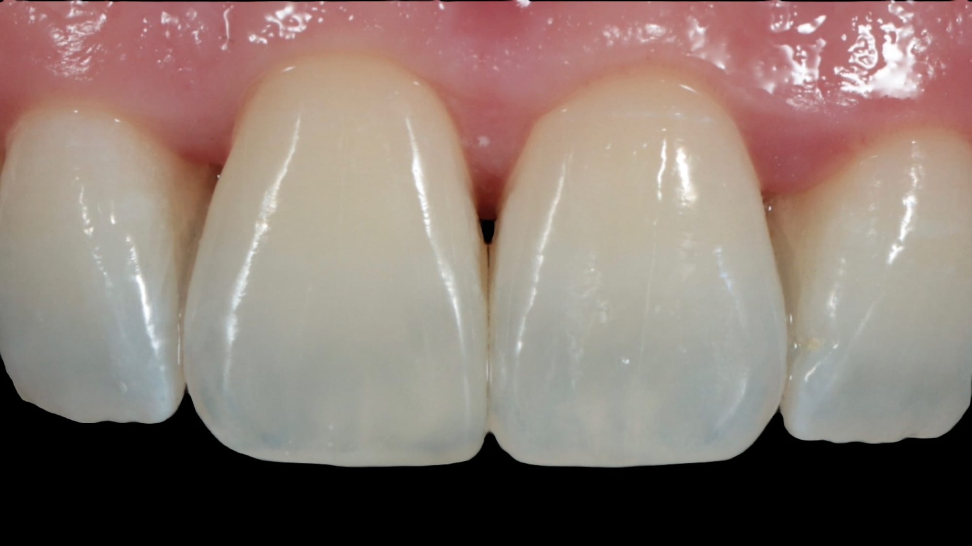 After — Fixing chipped edge of tooth