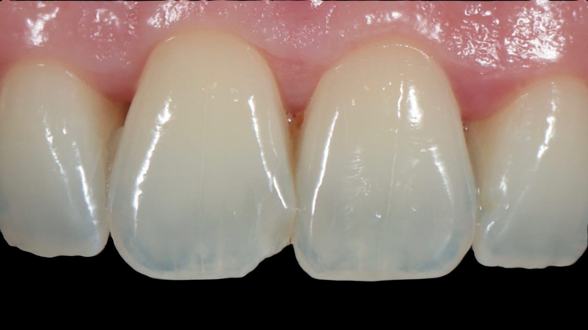 Before — Fixing chipped edge of tooth