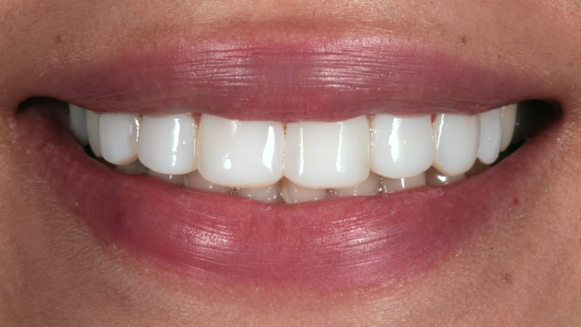 Before — Flared, poorly contoured bonding replaced — 10x natural composite veneers