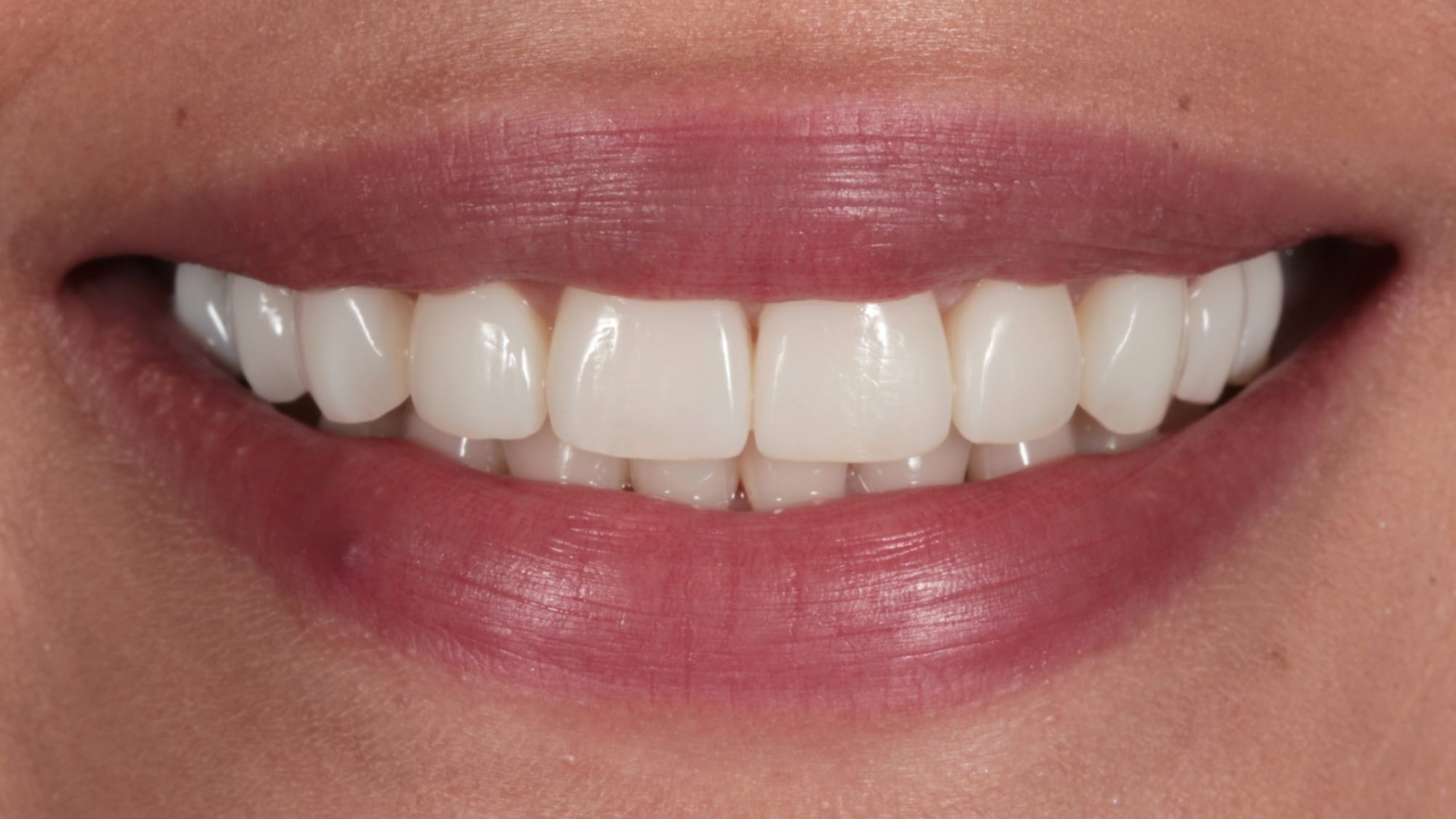 After — Flared, poorly contoured bonding replaced — 10x natural composite veneers