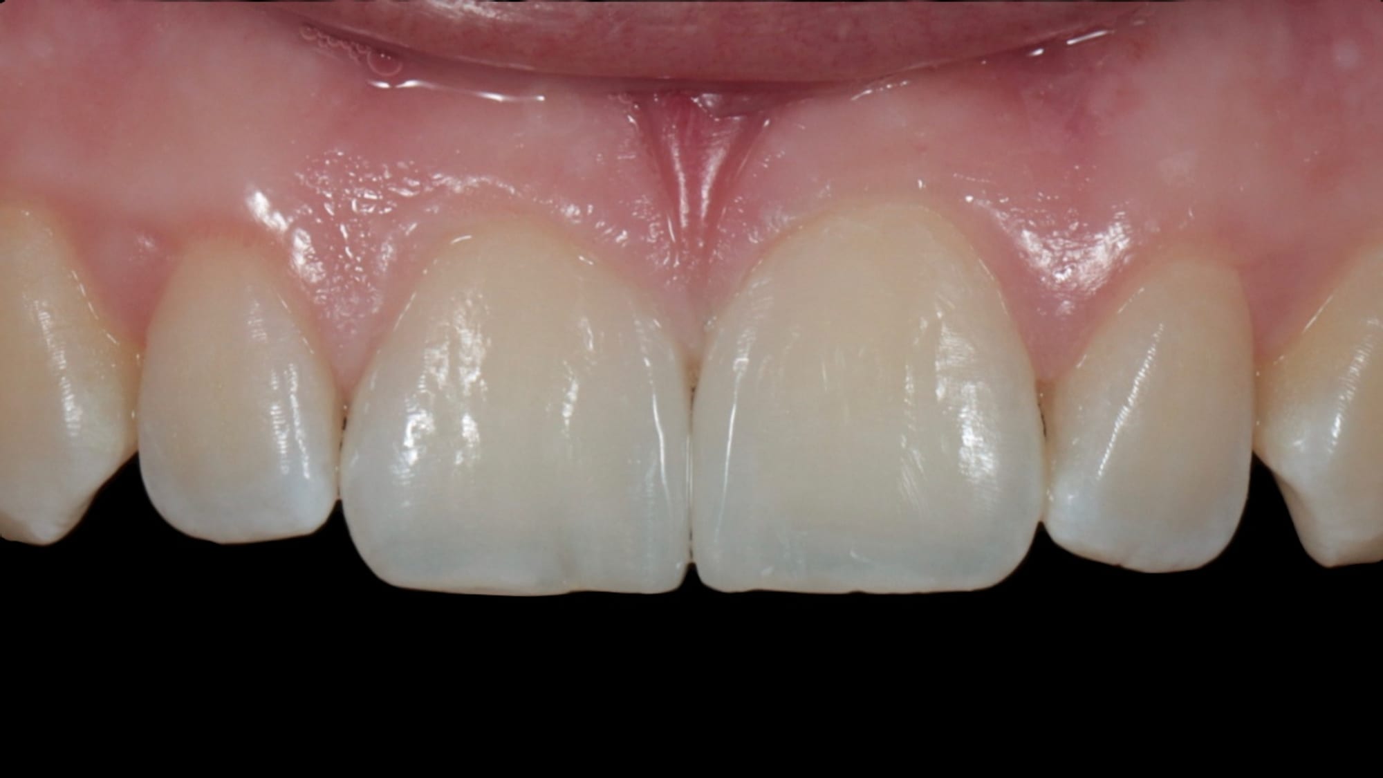 After — Gap closure with composite