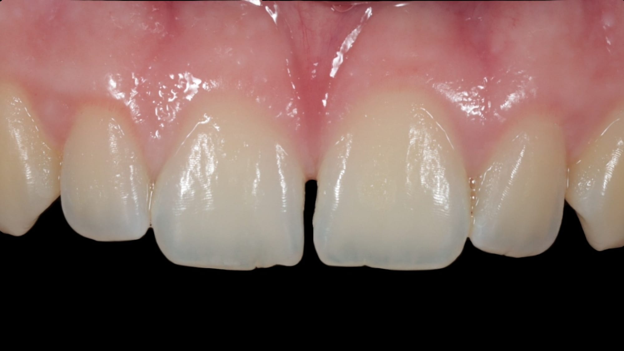 Before — Gap closure with composite