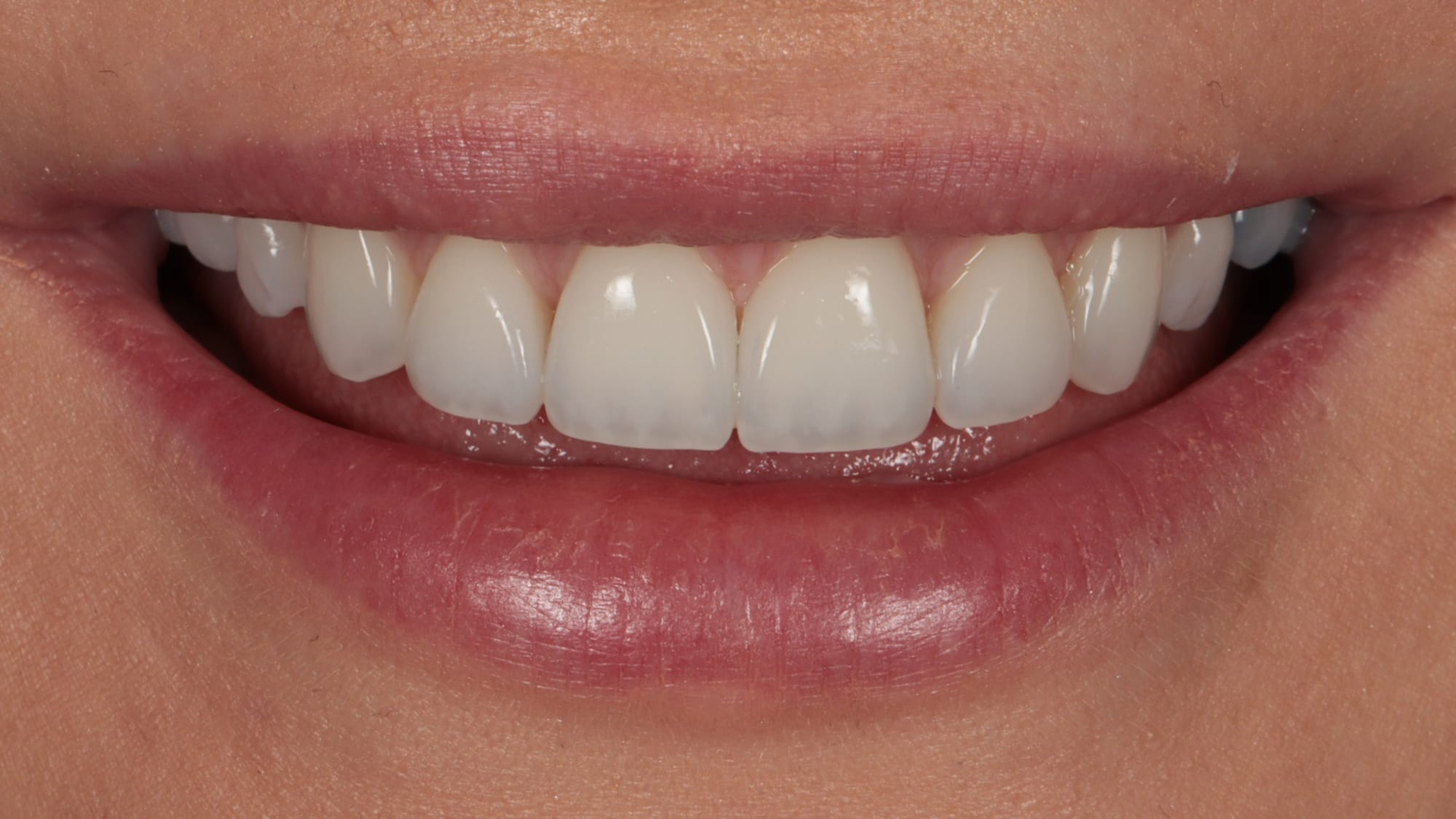After — 6x natural composite bonding — improving gaps and shape