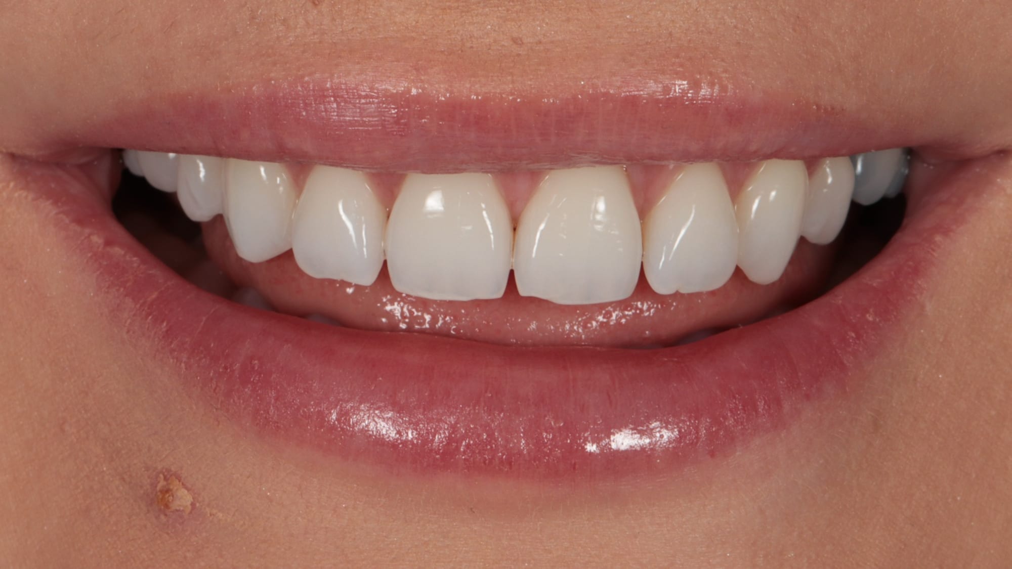 Before — 6x natural composite bonding — improving gaps and shape