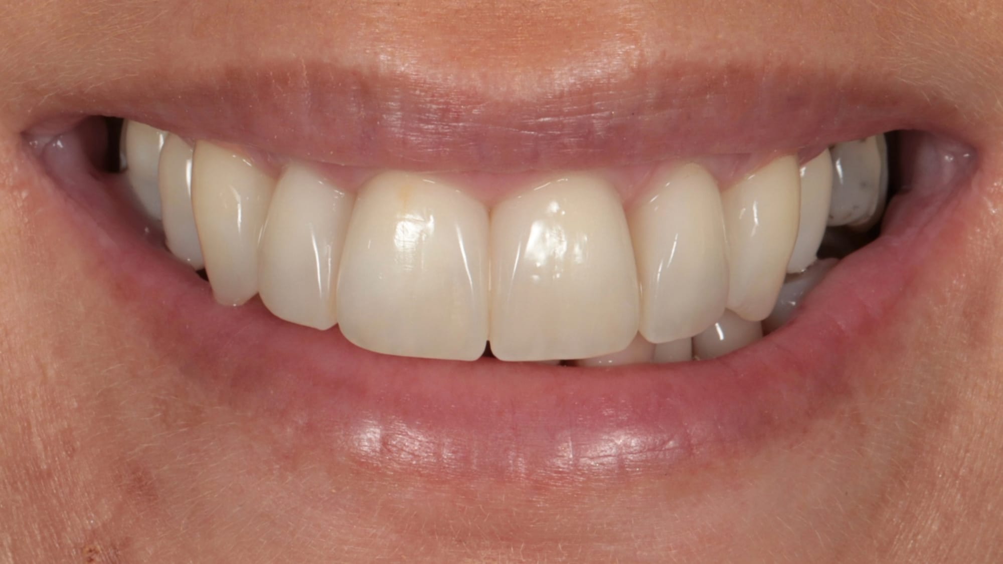 After — 6x natural composite bonding — gaps and black triangles