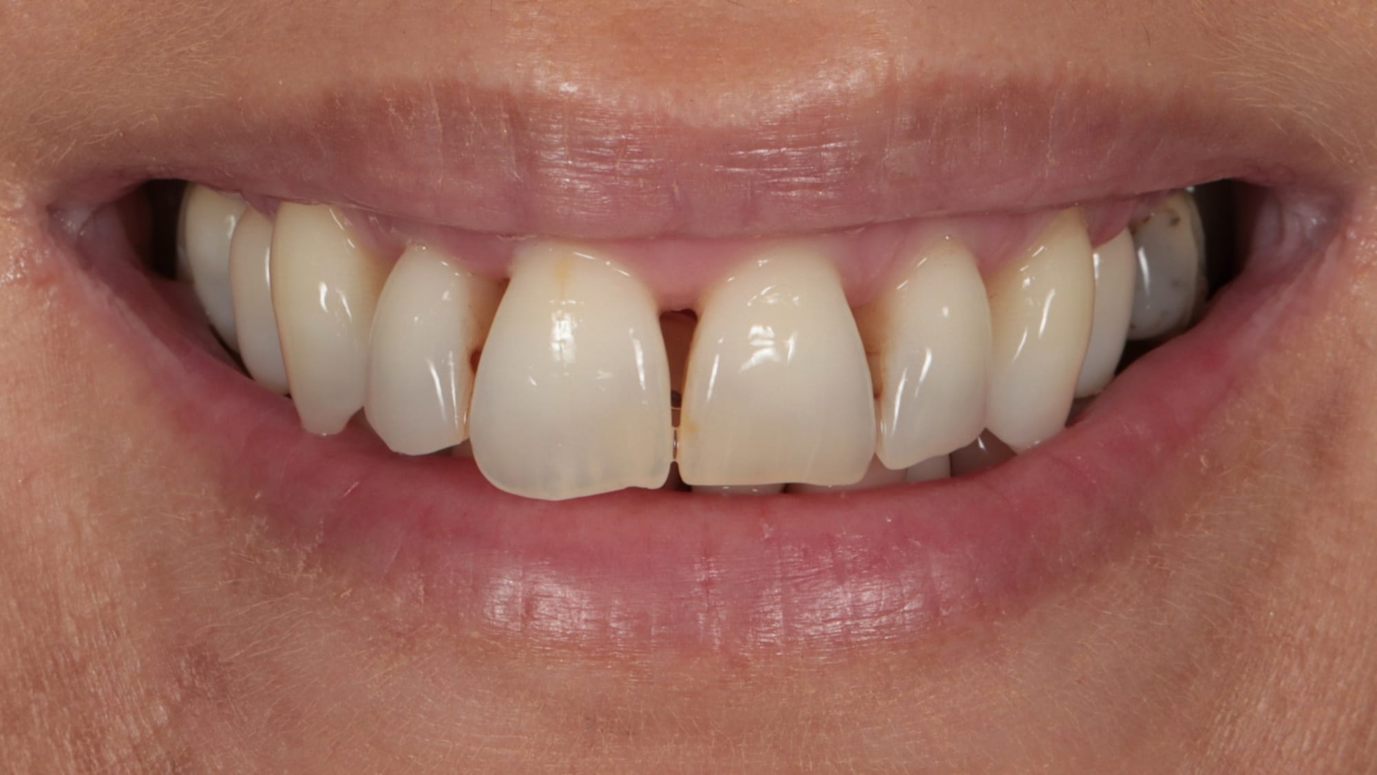 Before — 6x natural composite bonding — gaps and black triangles
