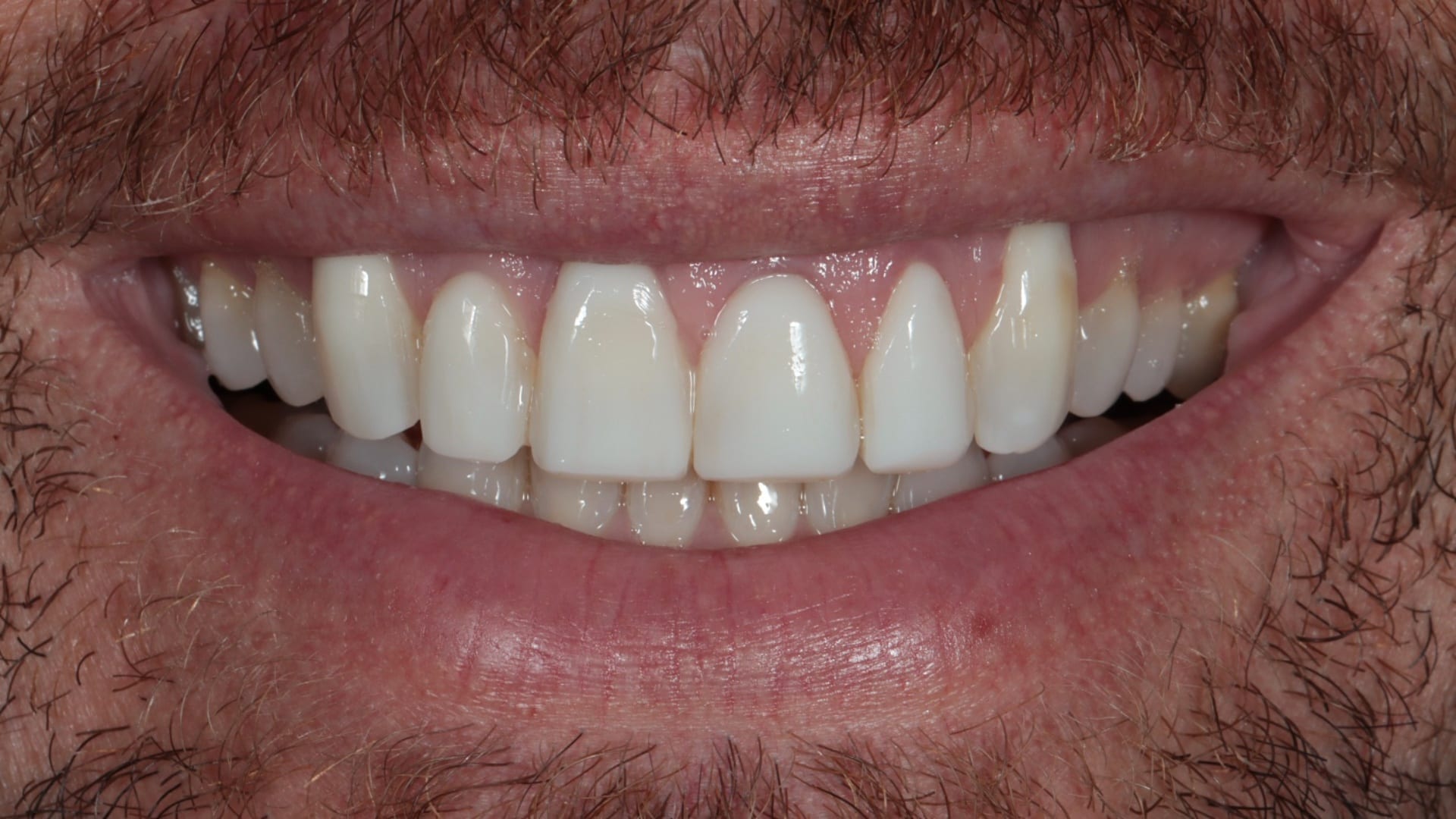 Before — Gum recession coverage — 10x natural composite veneers with pink composite