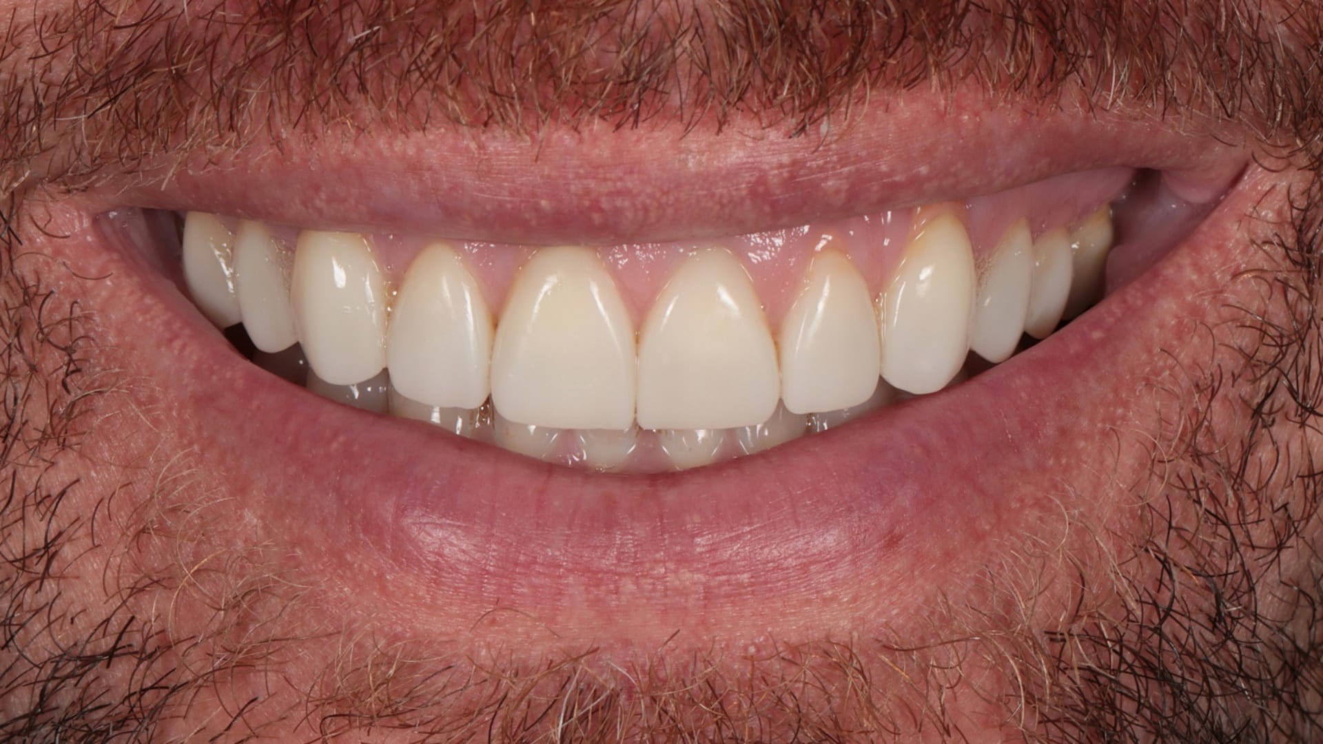 After — Gum recession coverage — 10x natural composite veneers with pink composite