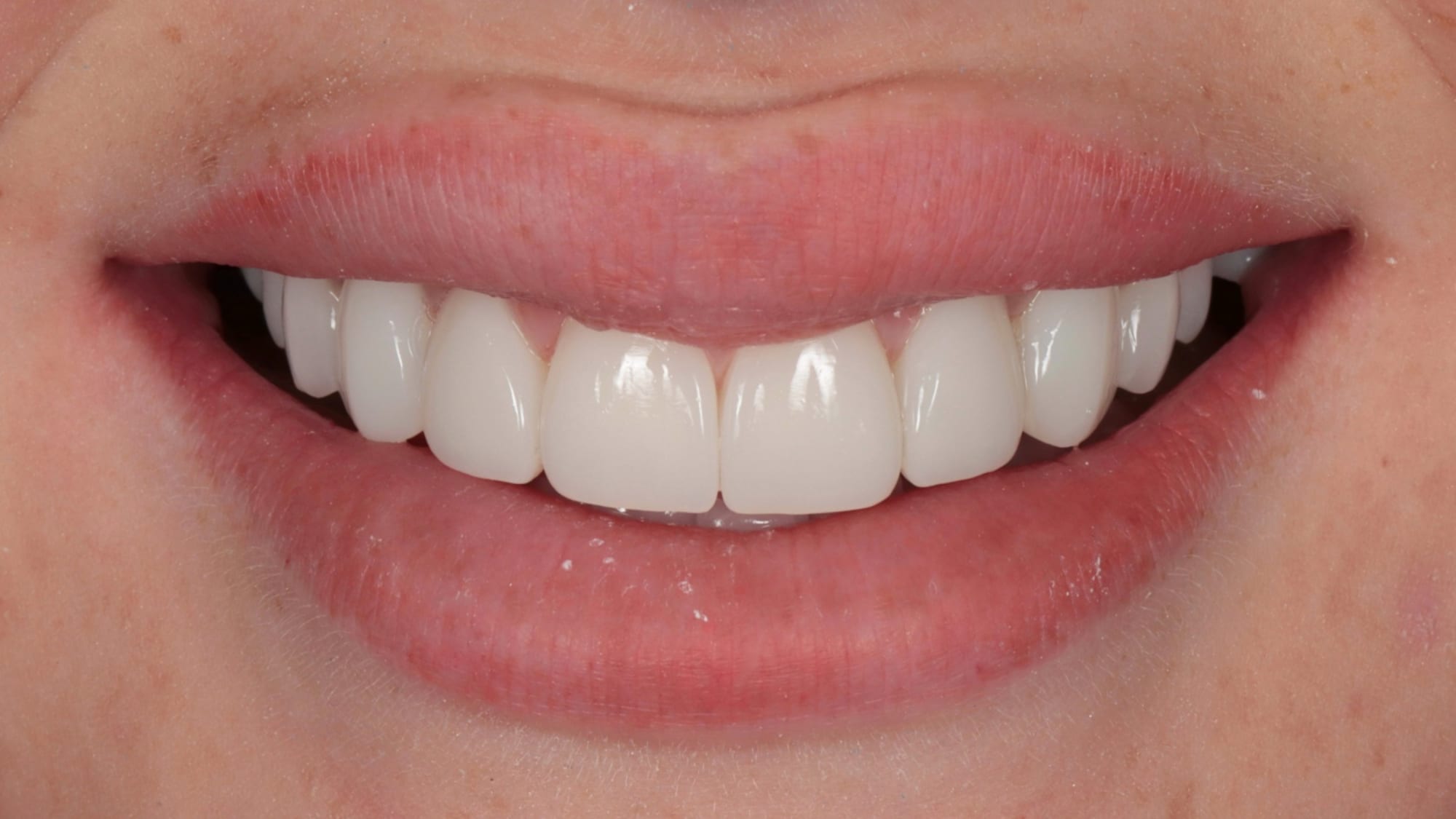 After — 10x composite veneers — Hollywood style