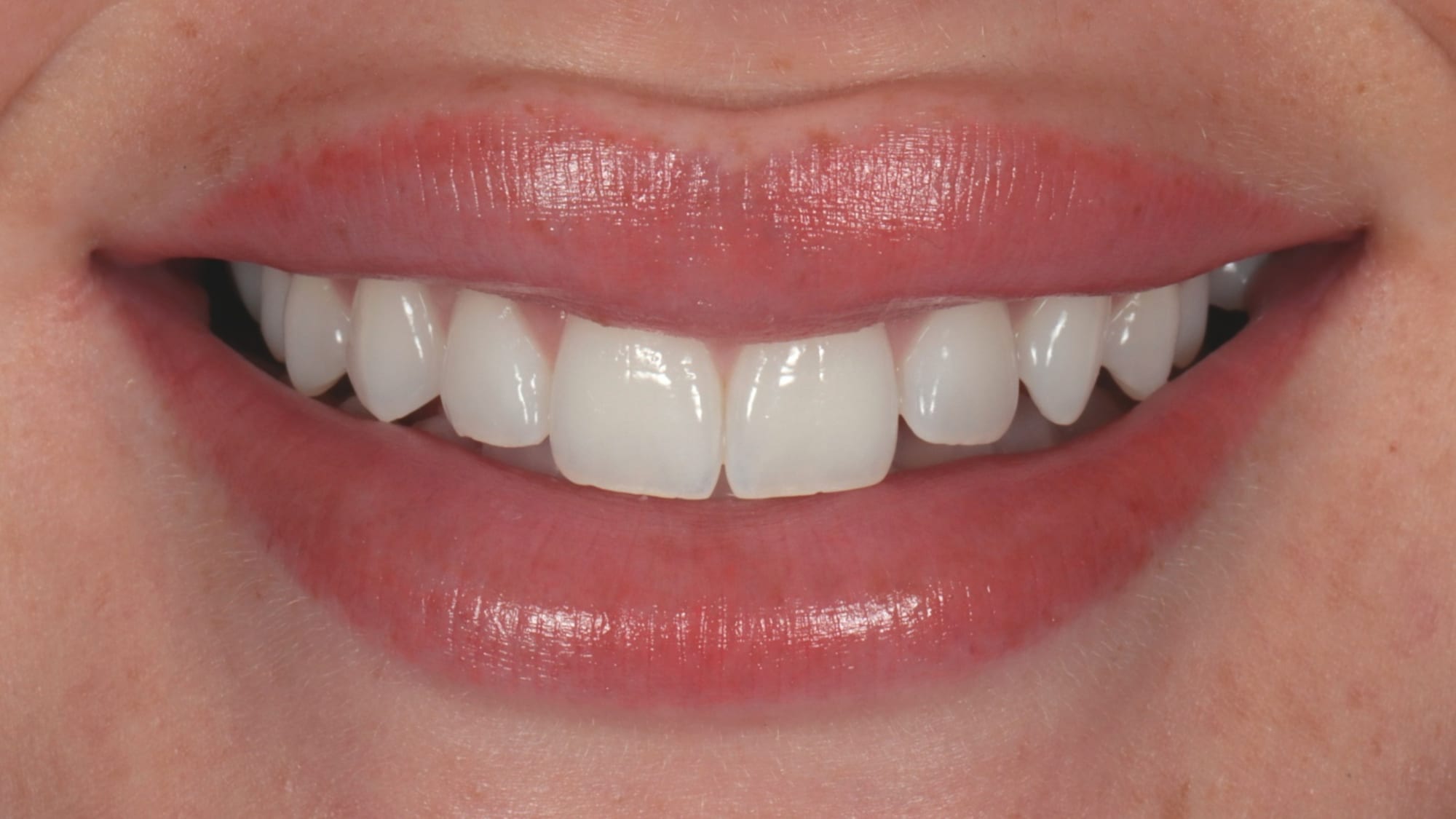 Before — 10x composite veneers — Hollywood style