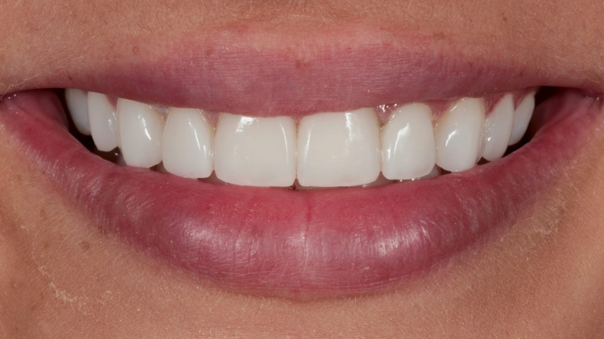 After — Hollywood composite bonding — fuller and brighter