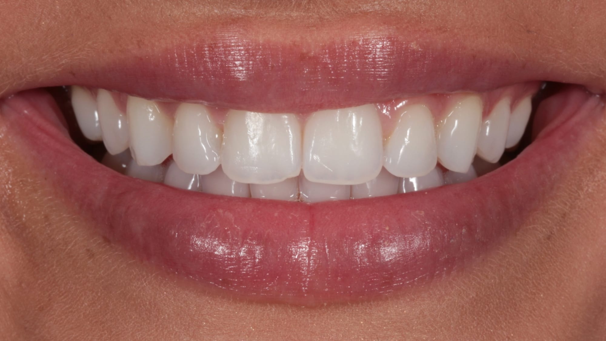 Before — Hollywood composite bonding — fuller and brighter