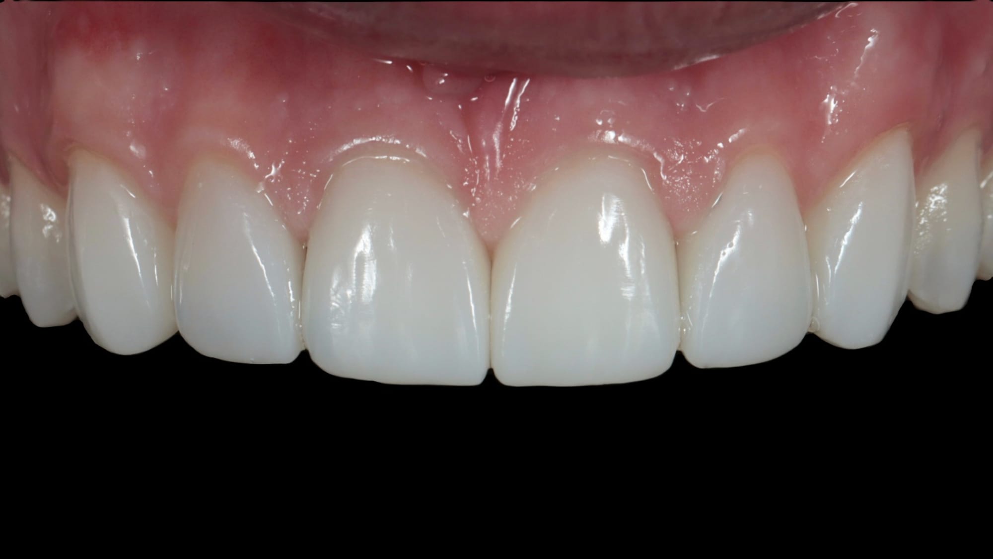 After — Closing gaps — 6x Hollywood-style composite veneers