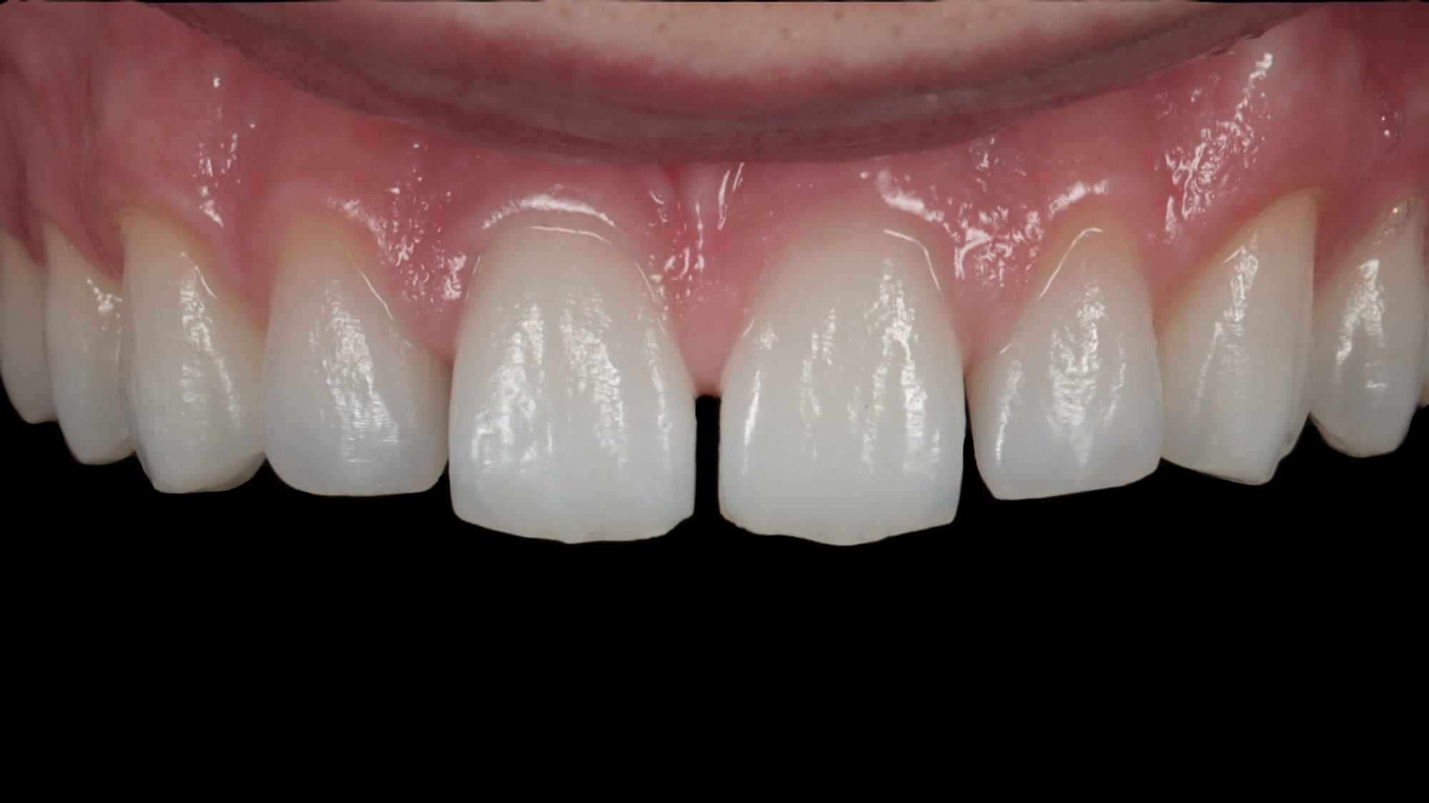 Before — Closing gaps — 6x Hollywood-style composite veneers