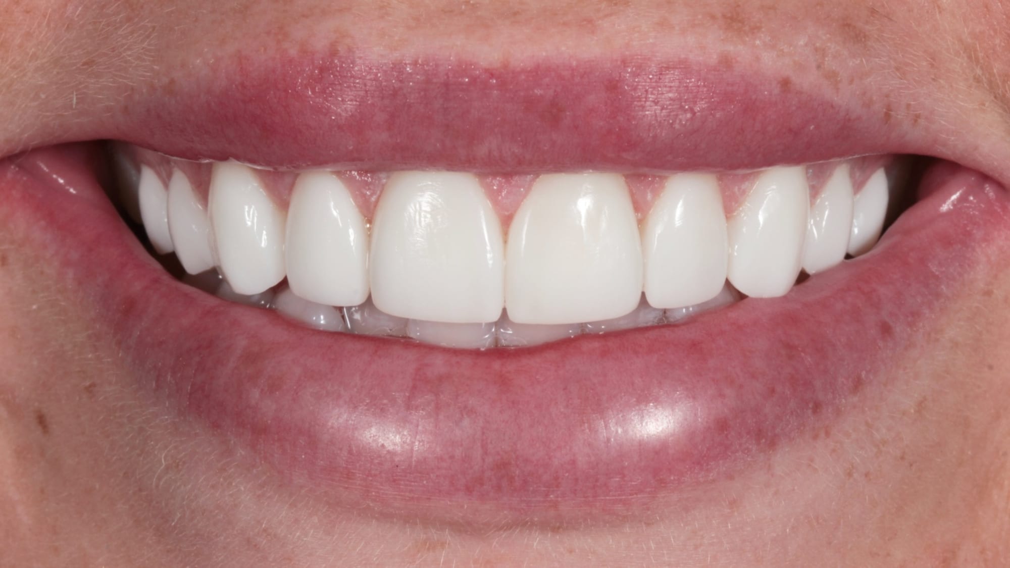 After — 10x Hollywood-style composite veneers