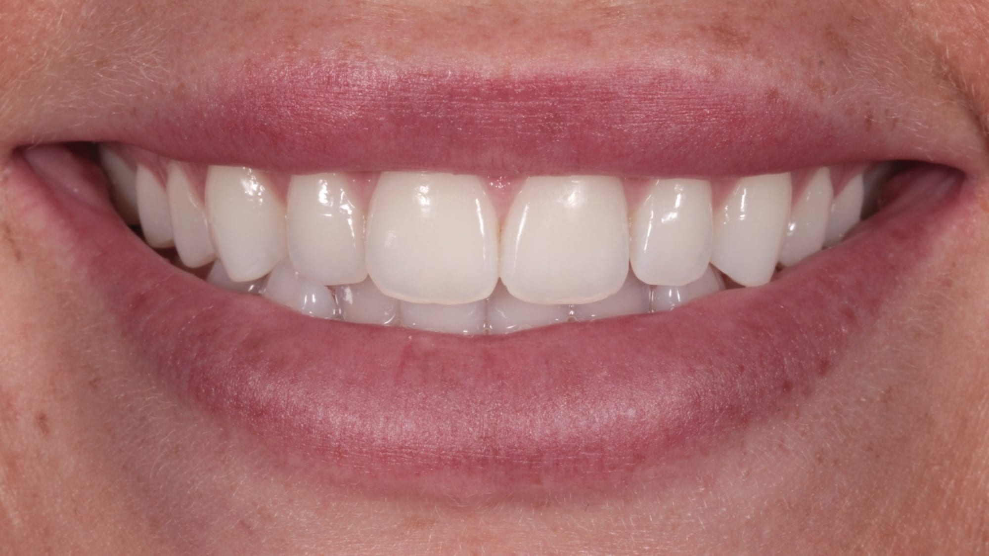 Before — 10x Hollywood-style composite veneers