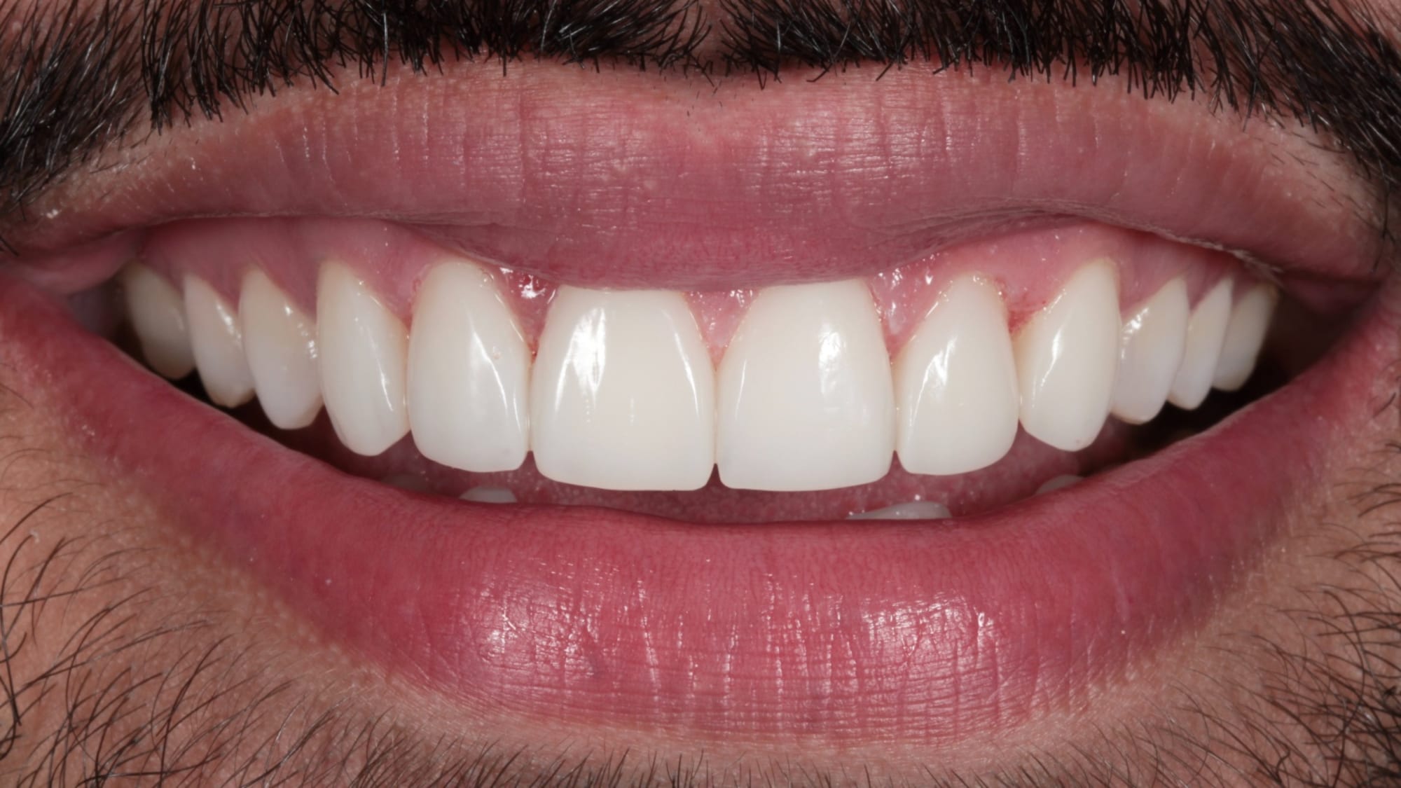 After — Hollywood composite bonding smile makeover