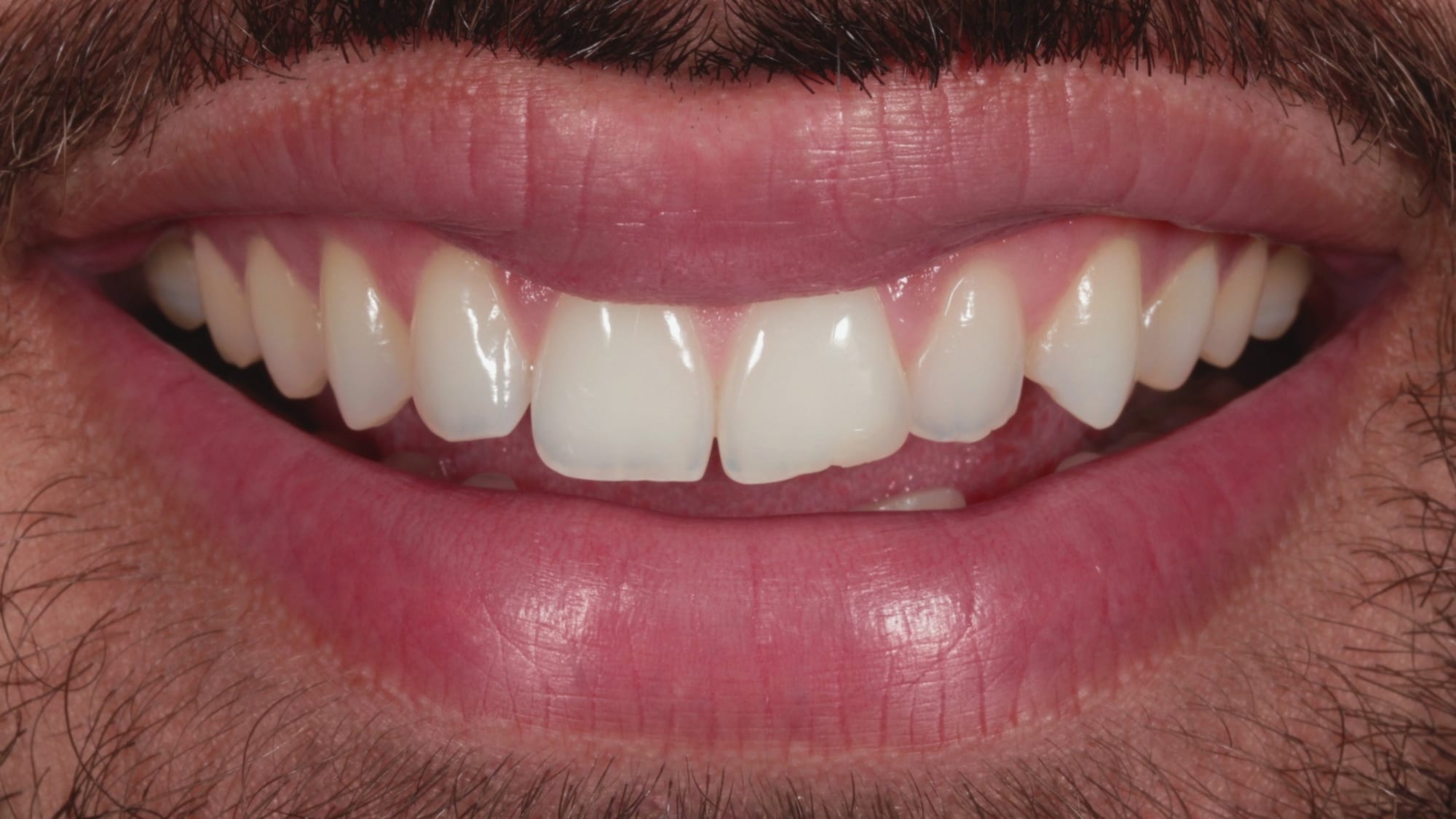 Before — Hollywood composite bonding smile makeover