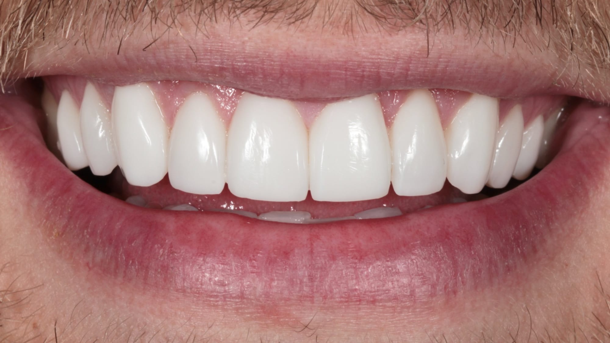 After — 10x Hollywood composite veneers
