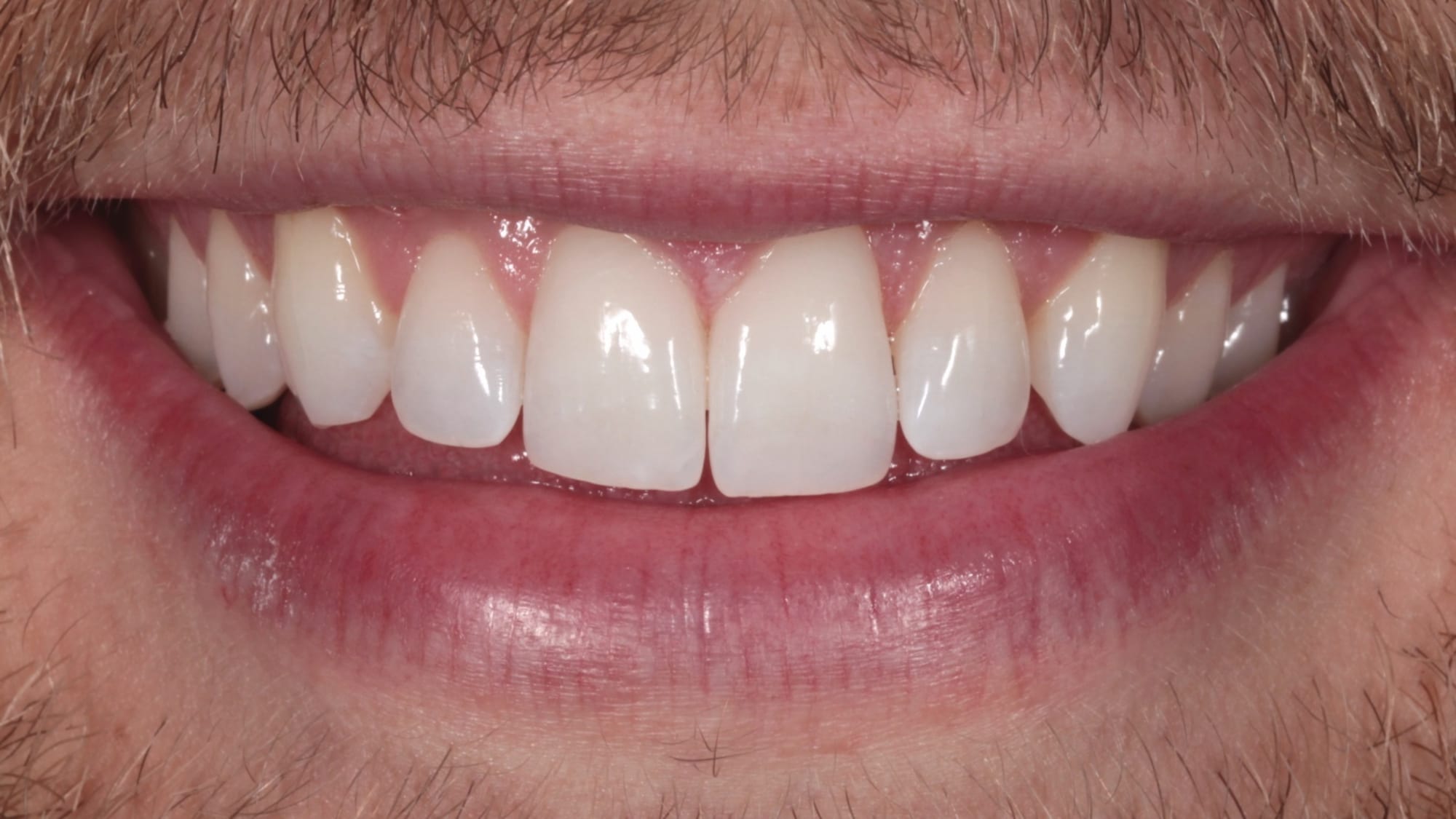 Before — 10x Hollywood composite veneers