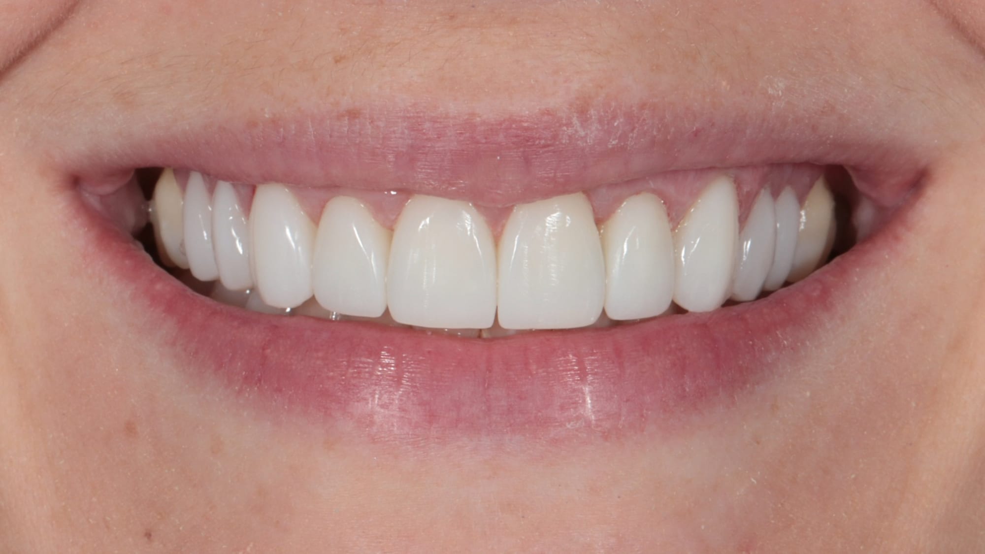 After — 10x Hollywood composite veneers/bonding