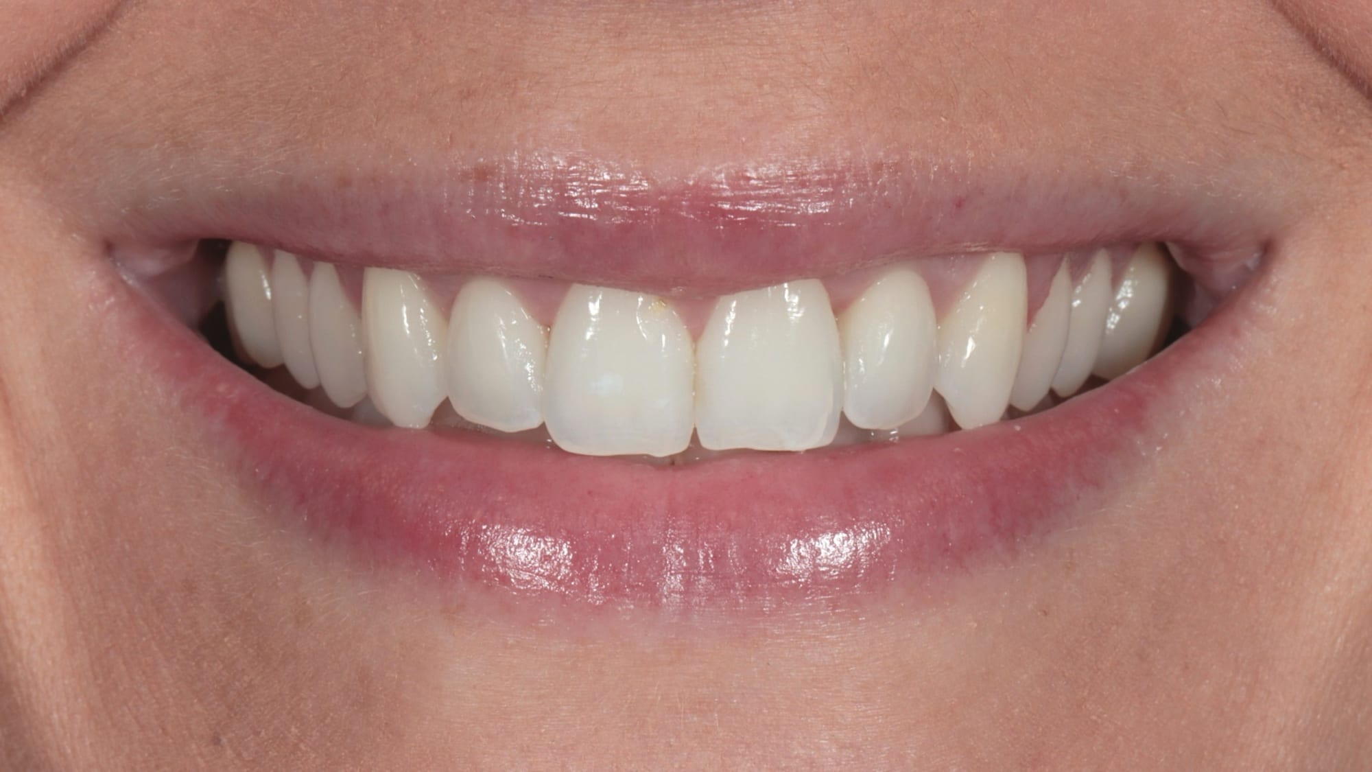 Before — 10x Hollywood composite veneers/bonding