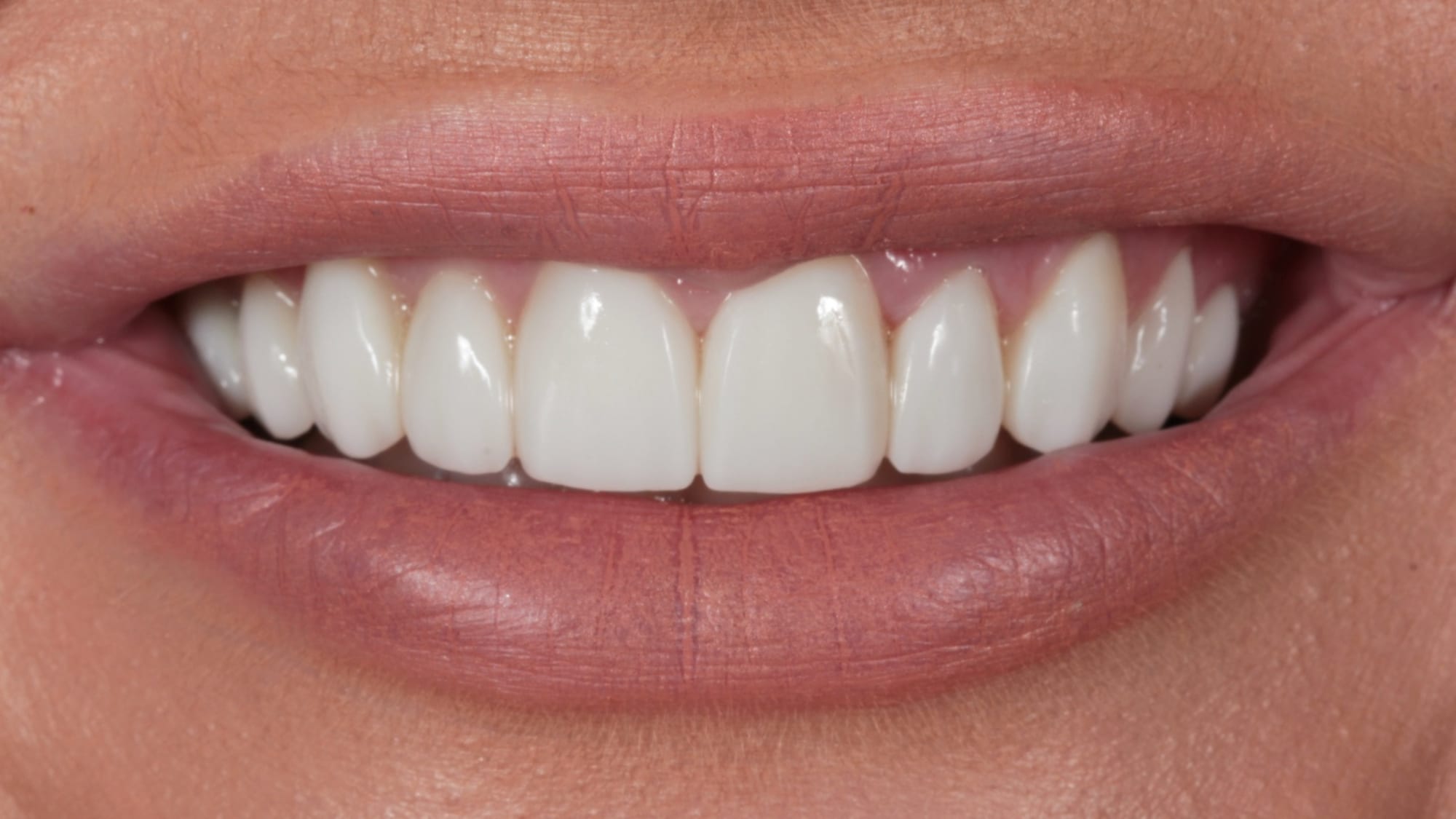 After — 8x Hollywood composite veneers/bonding