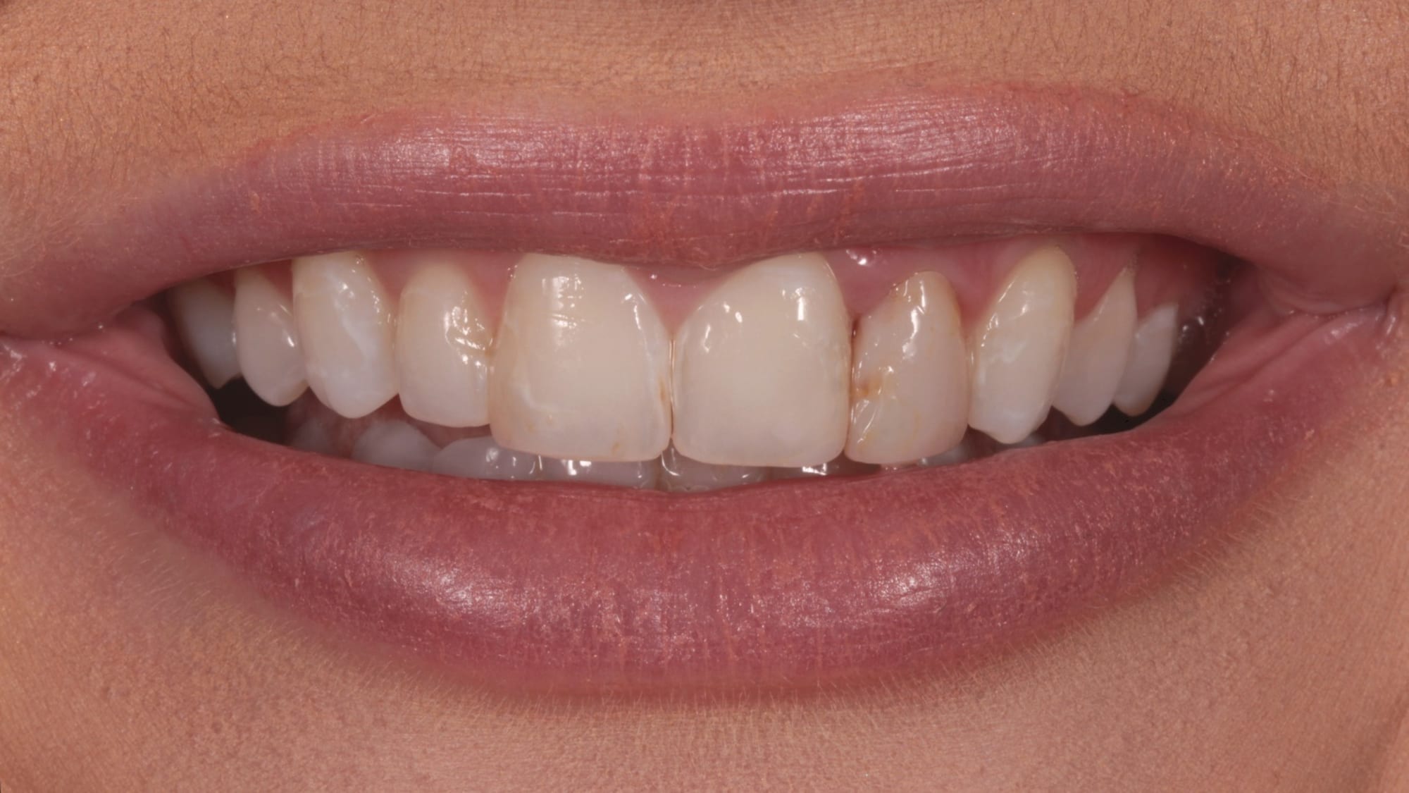Before — 8x Hollywood composite veneers/bonding