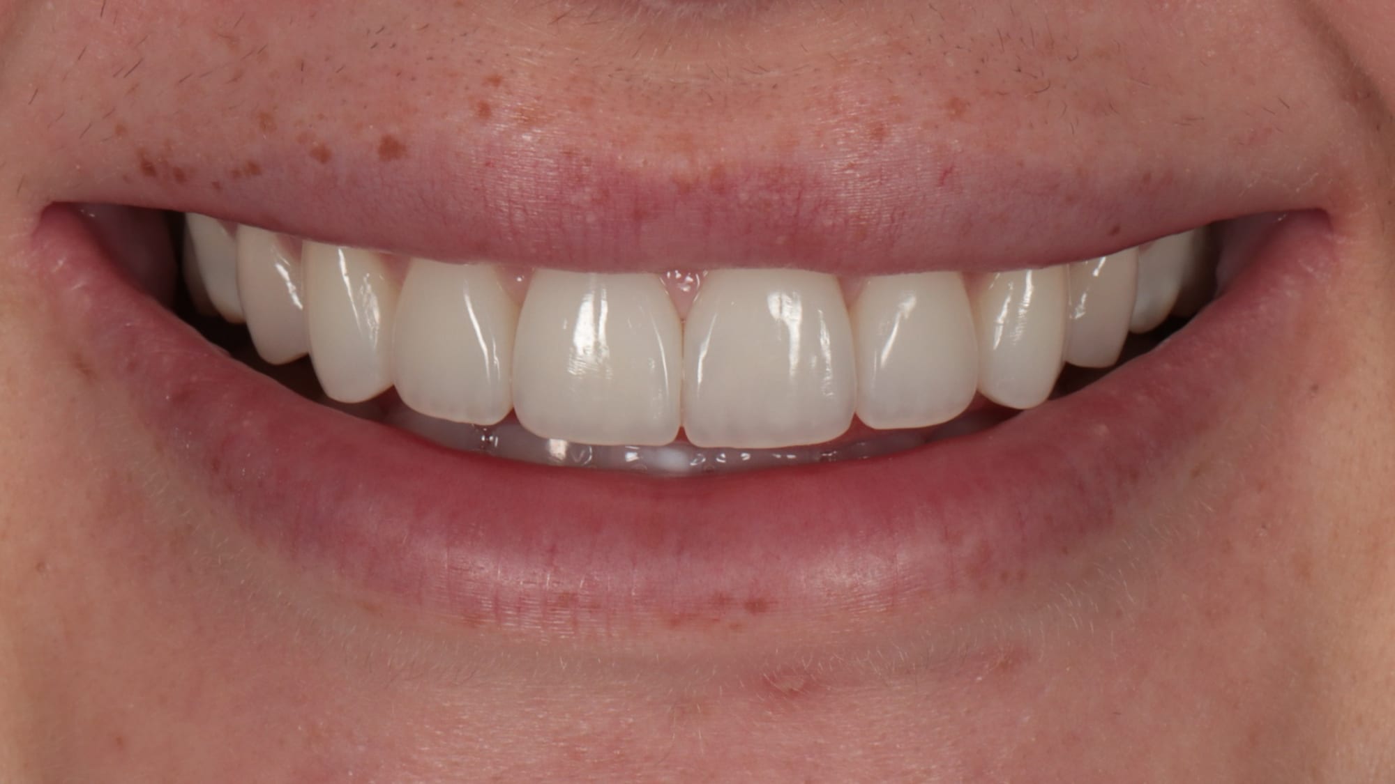 After — ICON white spot treatment + 6x composites
