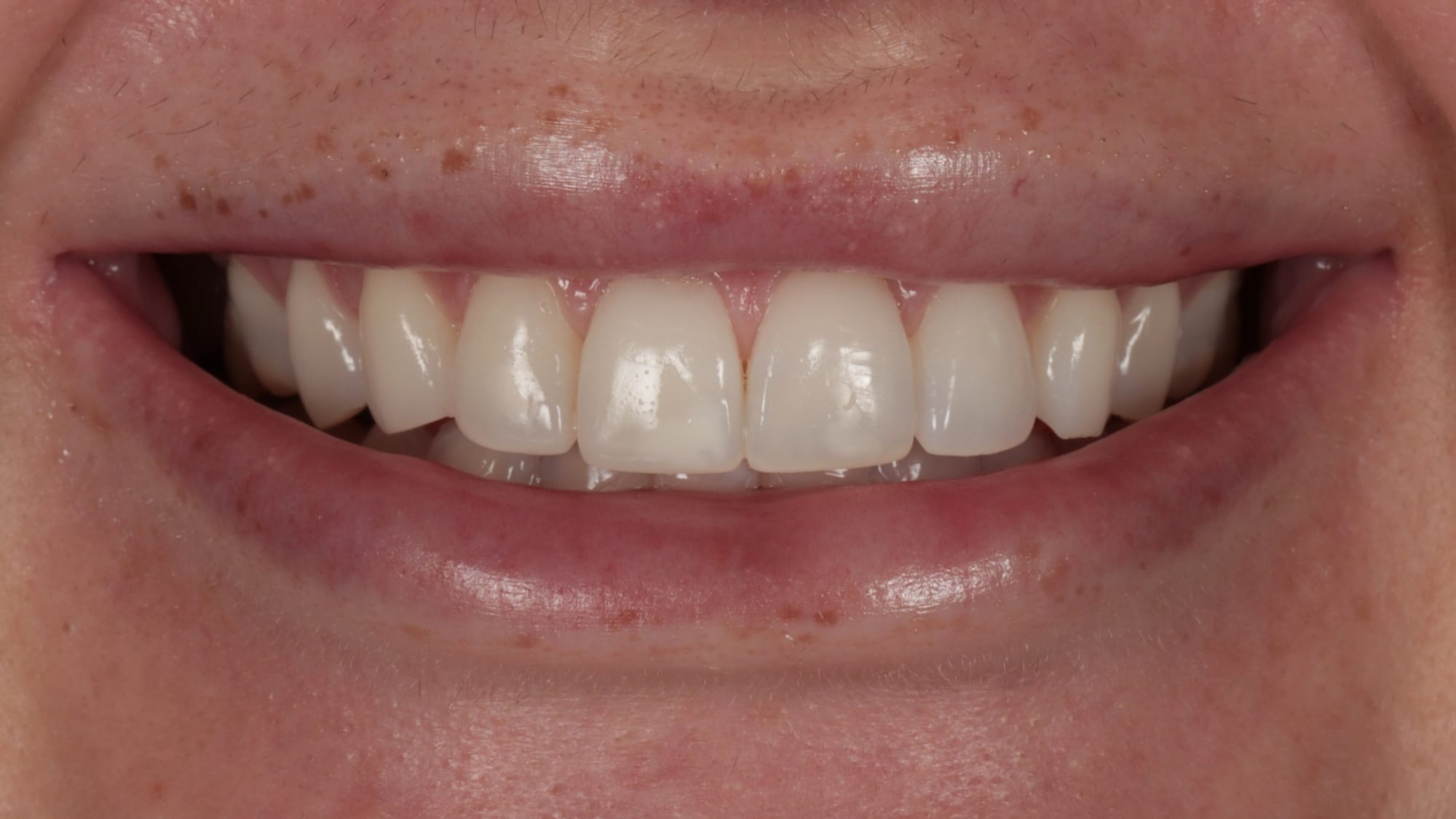 Before — ICON white spot treatment + 6x composites