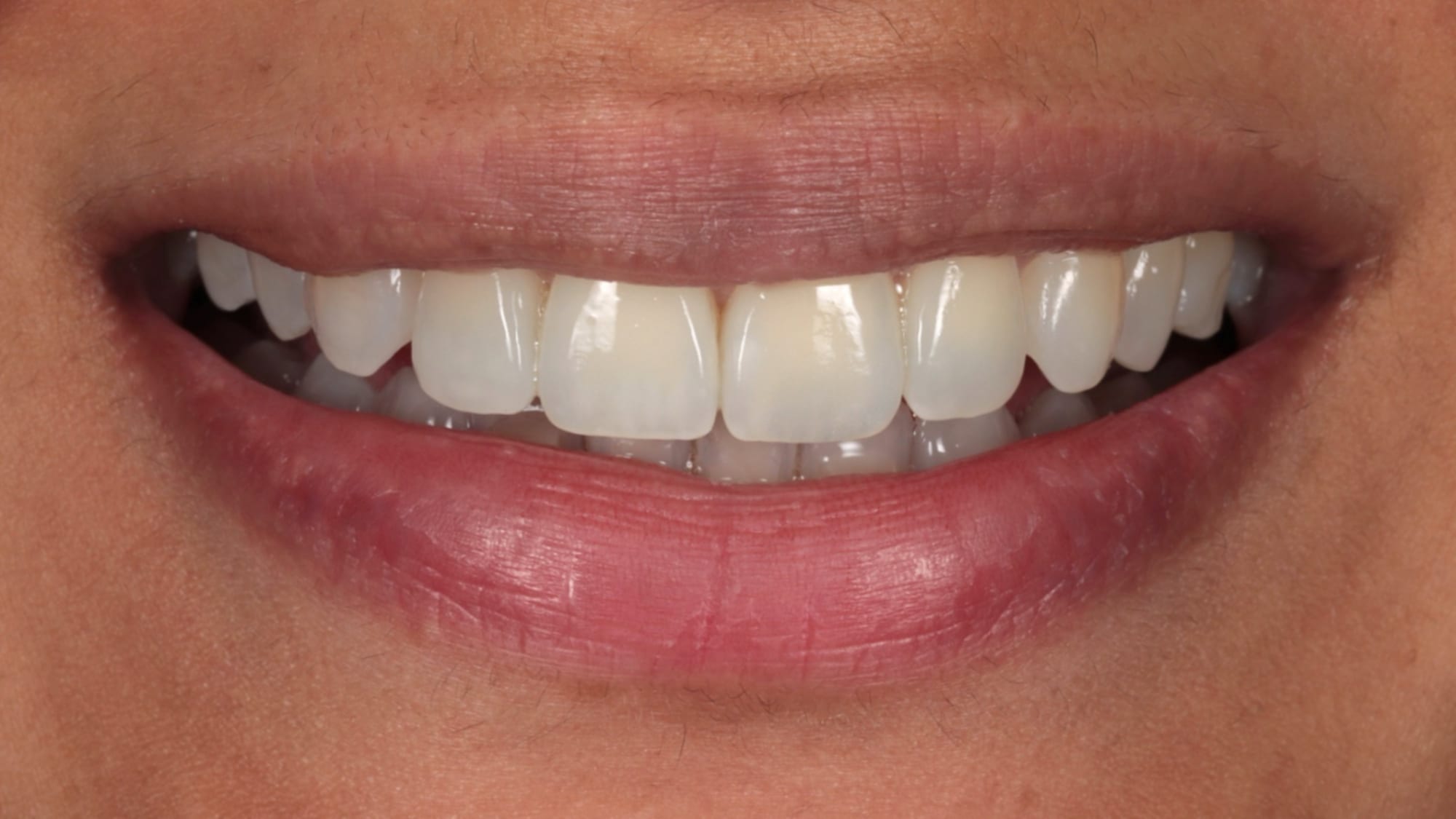 After — Invisalign and 4x composite bonding