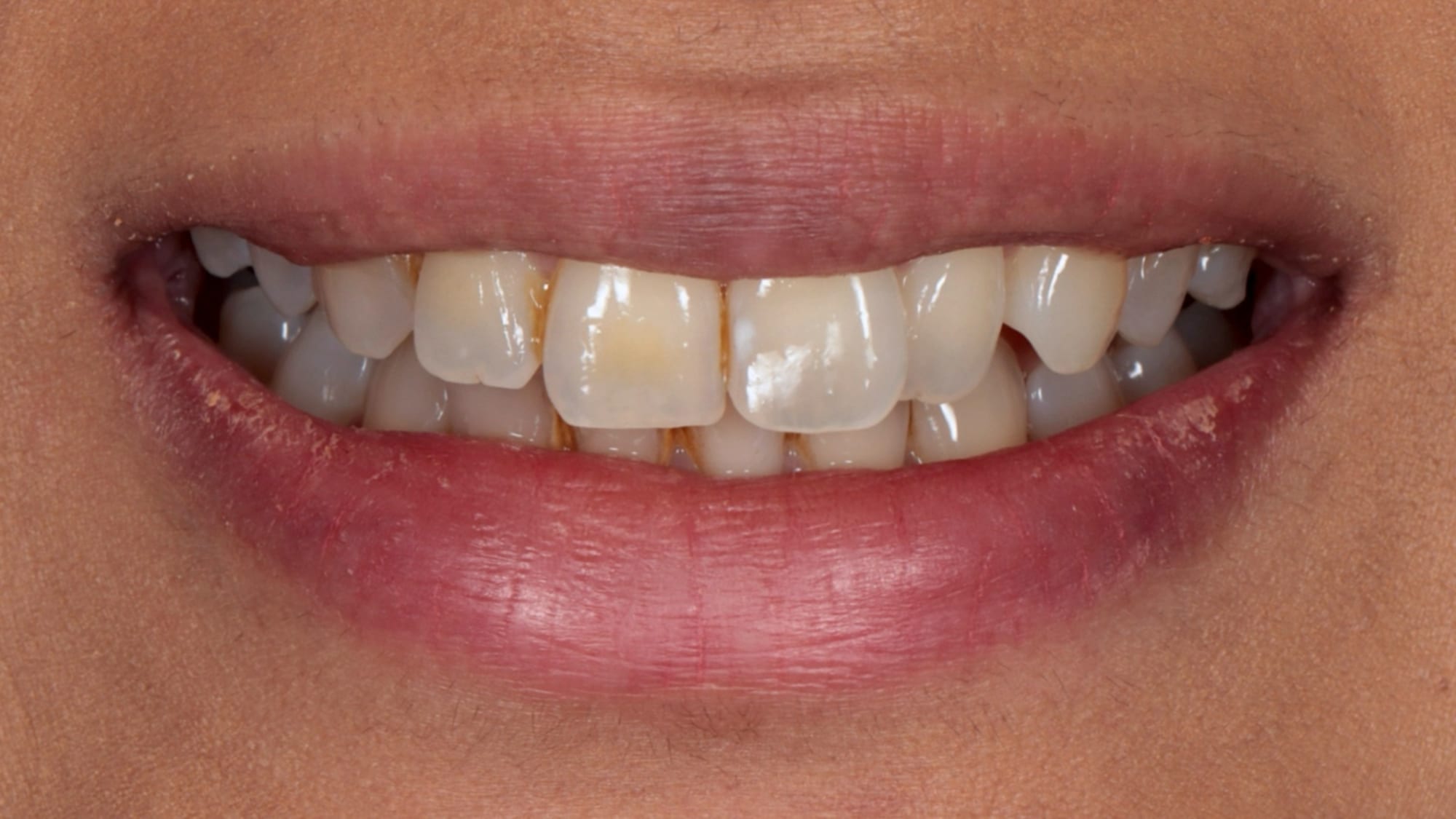 Before — Invisalign and 4x composite bonding