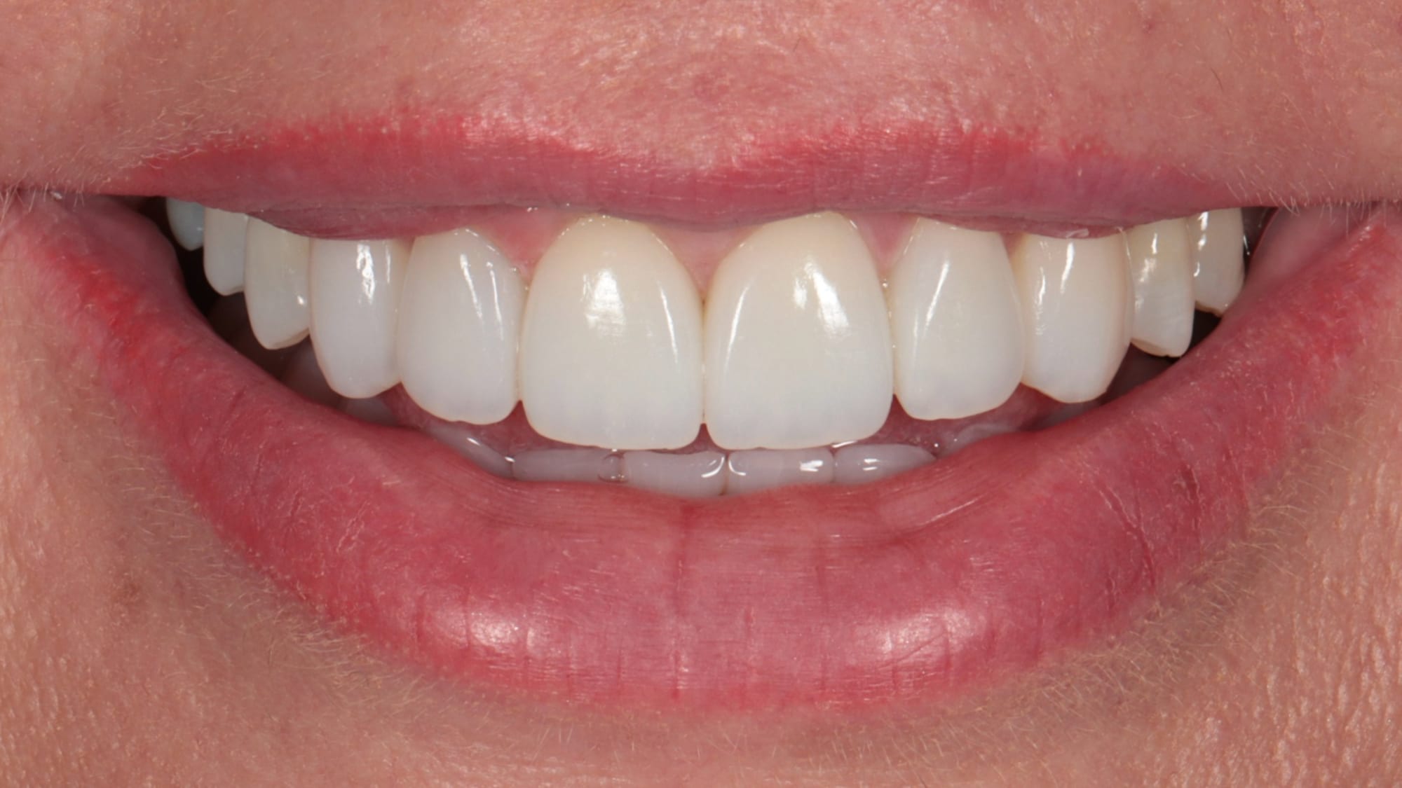 After — Invisalign and 6x natural composite veneers/bonding