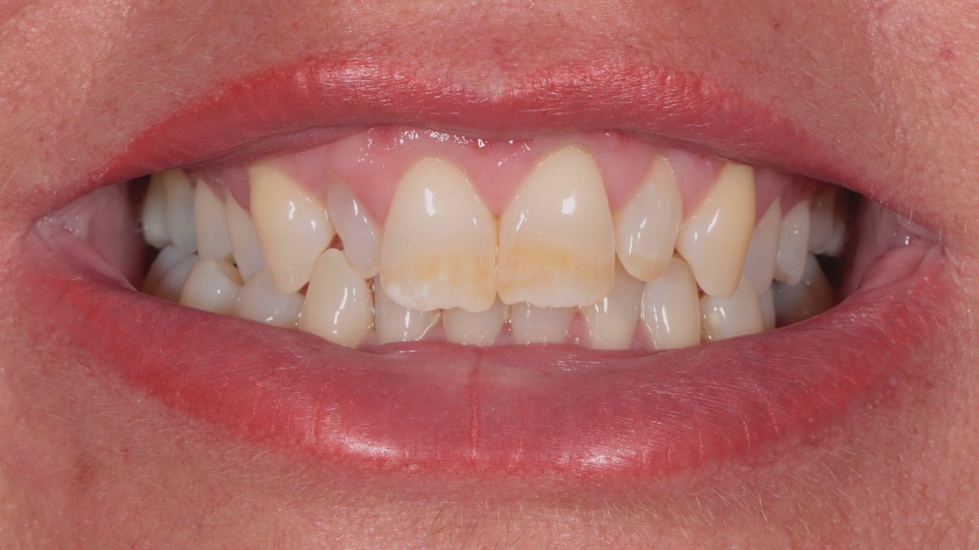 Before — Invisalign and 6x natural composite veneers/bonding