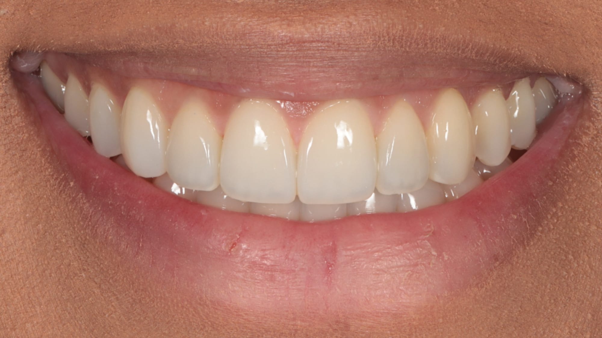 After — Invisalign and 8x natural composite veneers