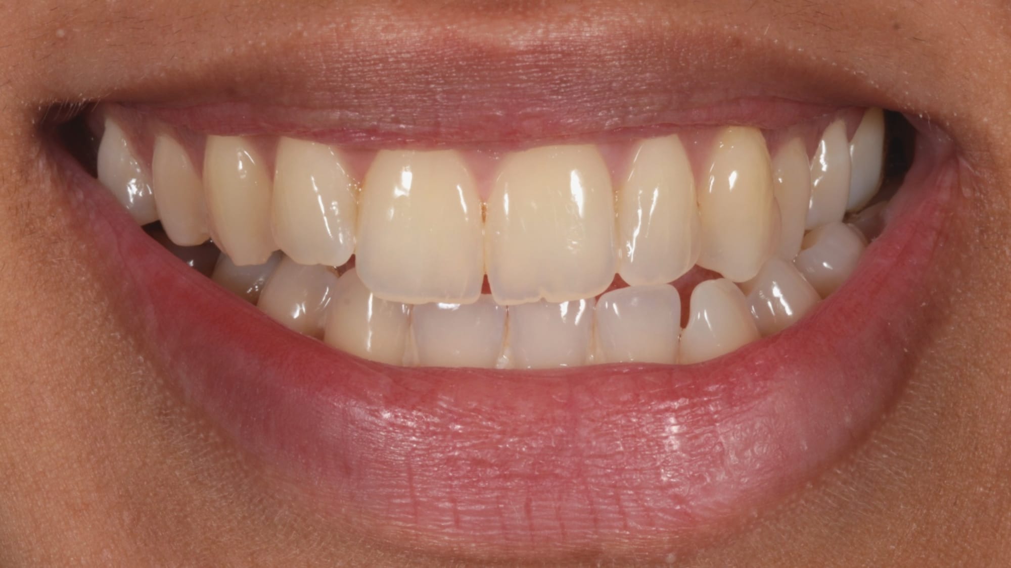 Before — Invisalign and 8x natural composite veneers