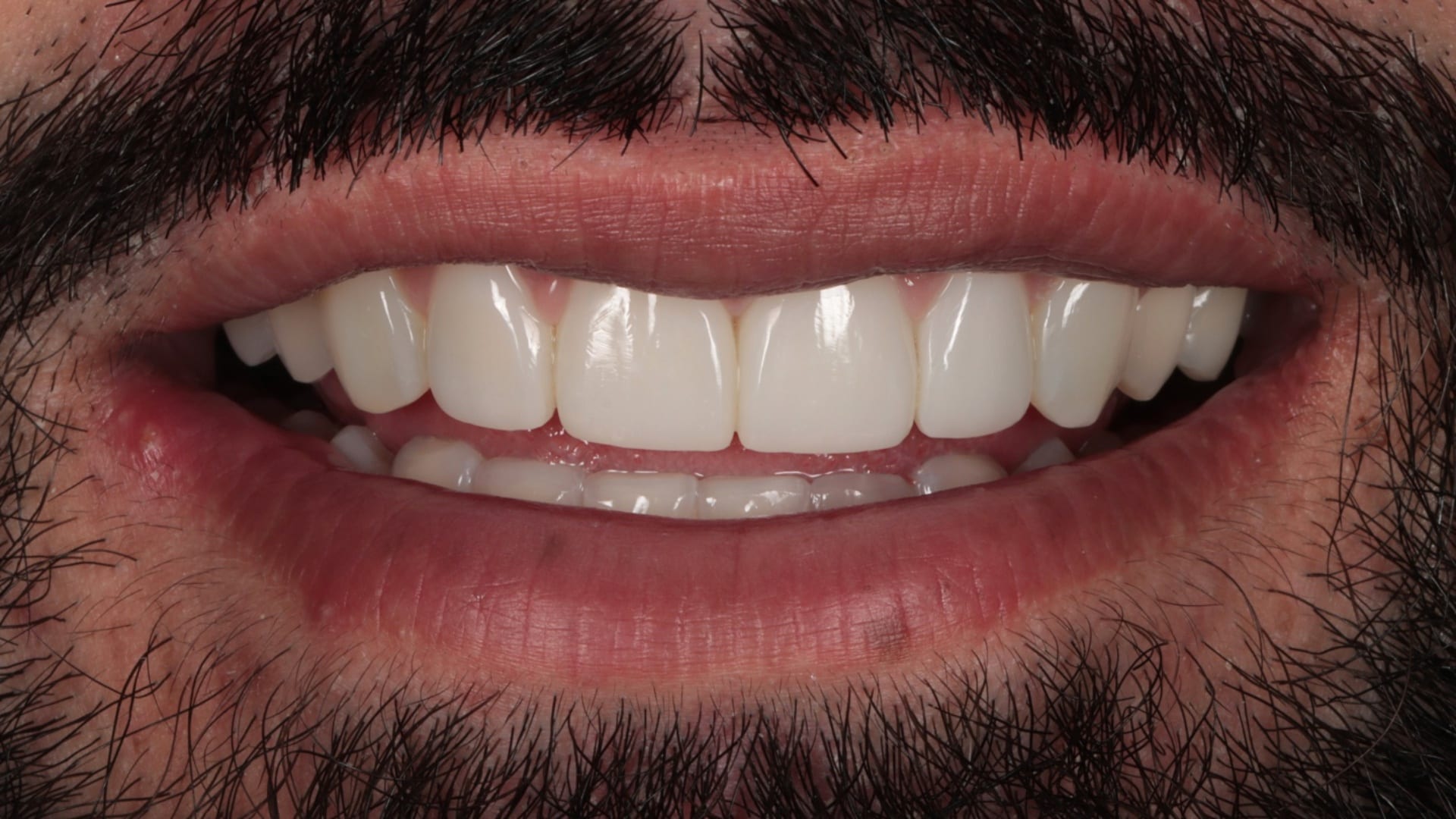 After — Invisalign and 6x composite veneers