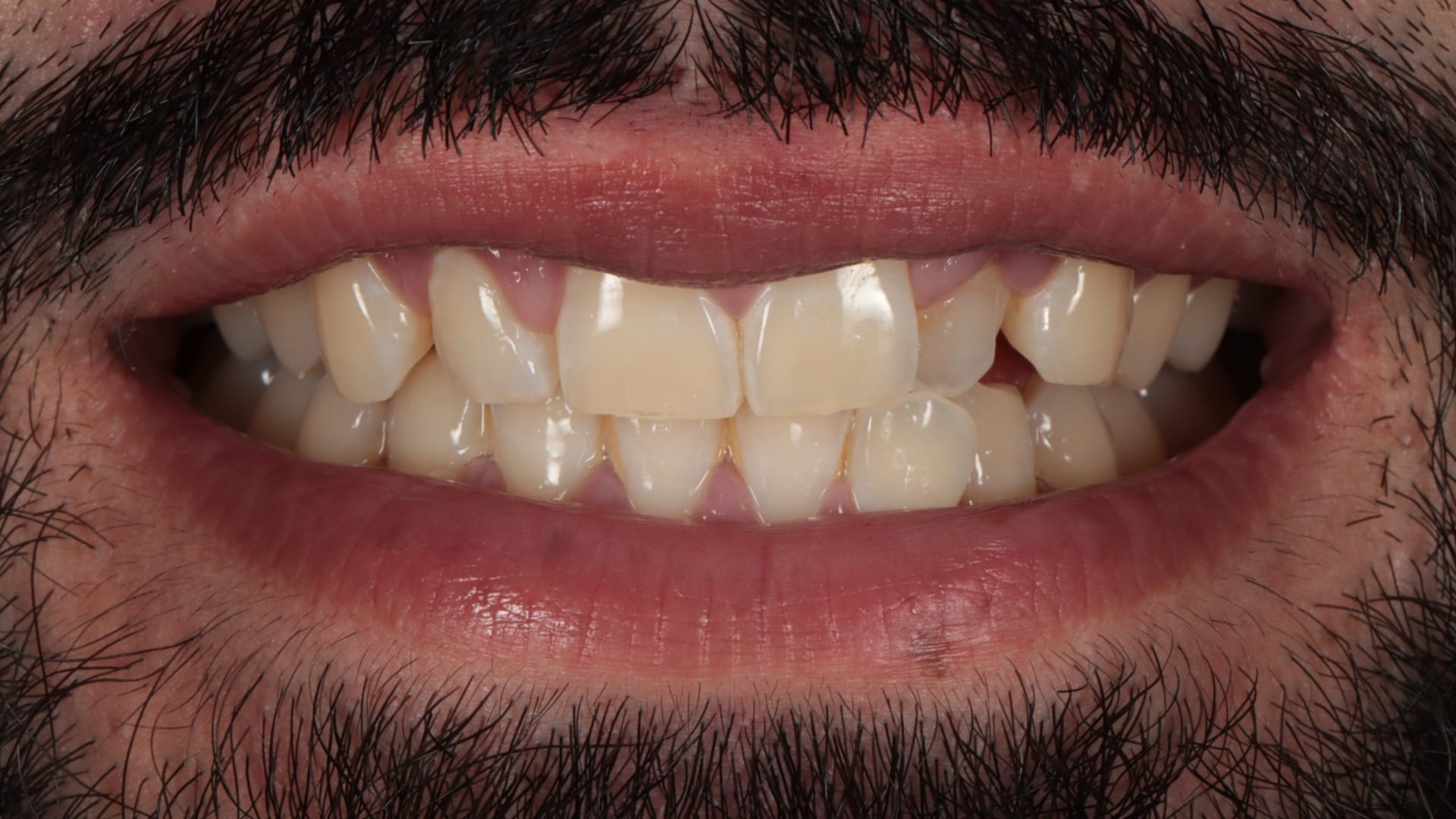 Before — Invisalign and 6x composite veneers